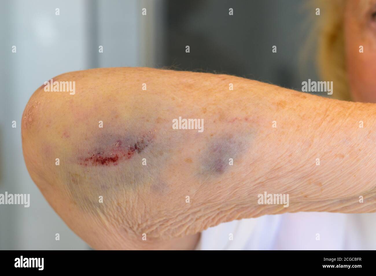 Donna anziana di 80 anni con gomito rotto o fratturato giunto che mostra il danno del tessuto molle e trauma a lei braccio dalla lesione Foto Stock