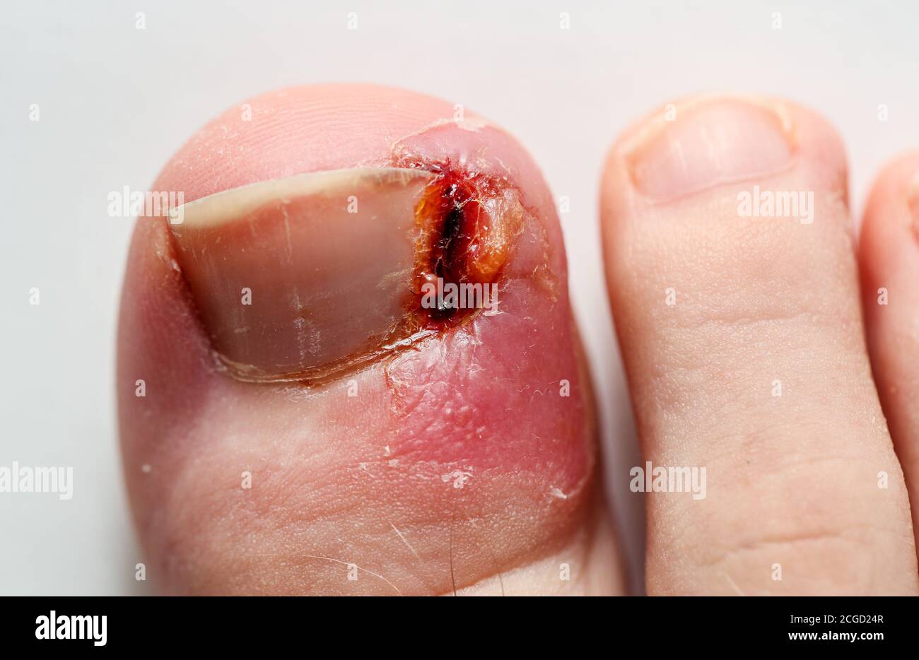 Una coda di rondine infetta sulla punta di un adolescente contro uno sfondo bianco. Foto Stock