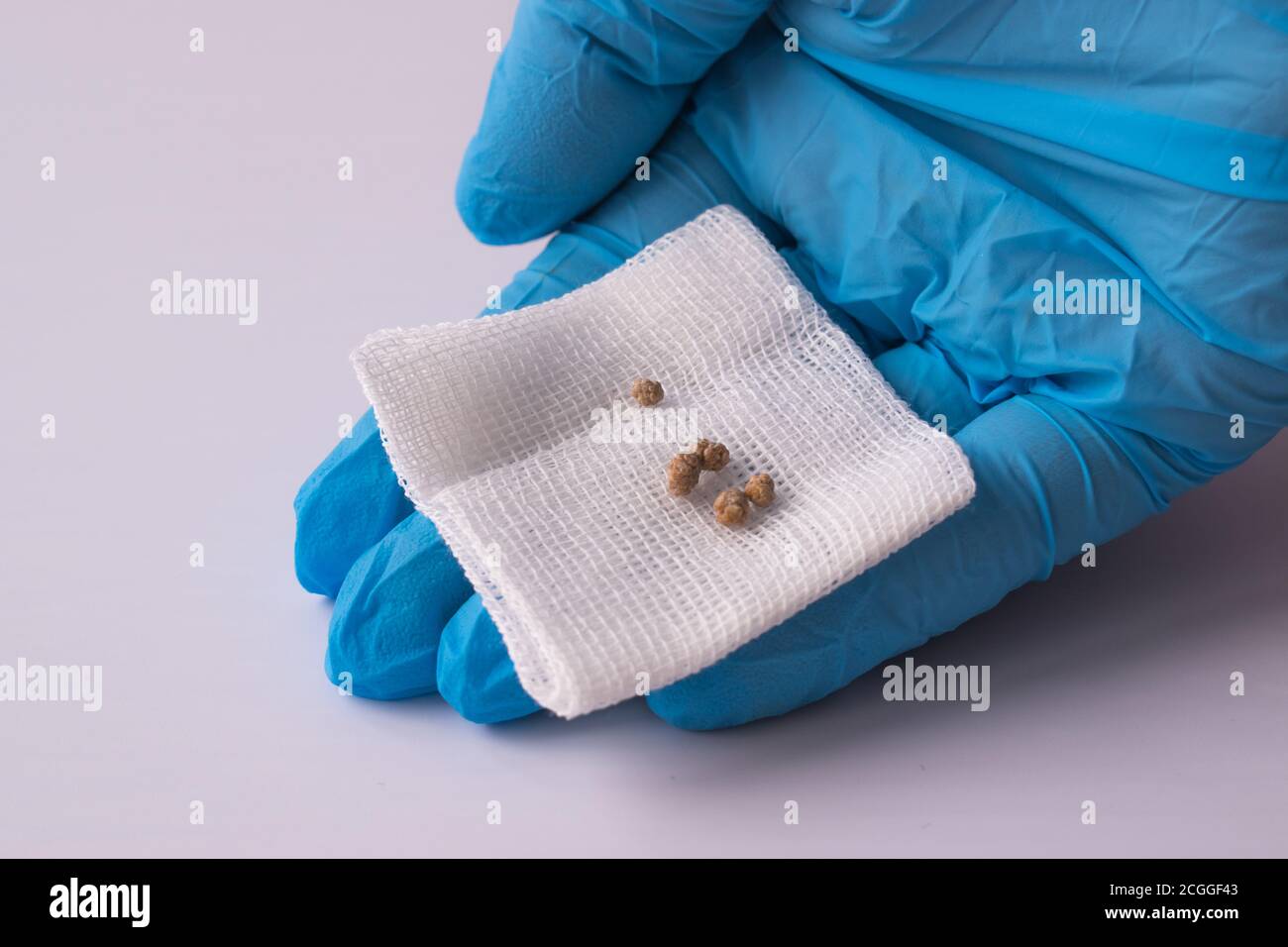 I calcoli della cistifellea dopo l'intervento di ESWL. Litotrissia. Colecistite. Foto Stock