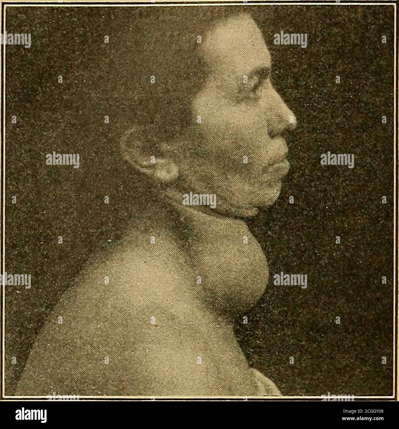 . Diagnosi fisica . Fig. 18.-ascesso cervicale nella malattia di Potts.(Bradford e Lovett.) DIAGNOSI FISICA. Cancro o sarcoma si sono verificati nella tiroide e possono essere diff-cult per distinguere dal gozzo. I tumori maligni sono solitamente dolorosi, crescono velocemente, sono accompaniati da emaciationand anemia, sono più duri e più nodulatedthan goitres benigni, andinvade i tis-sues vicini e linfatici. La sua esaminazionedovrebbe decidere in casi dubbi. IV. Torticollis (collo di vortici) e altre lesioni Re-sembling esso. (A) spasmo (tonico, rareliclonico) dello sterno-mas-toid e del trapezio May bedu Foto Stock