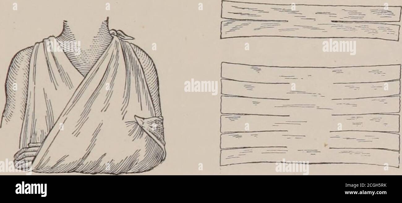 . Primo anno di cura : un testo-libro per gli allievi durante il loro primo anno di lavoro ospedaliero . La fermezza non deve essere sacrificata all'apparenza. Bendaggio triangolare. - questo è fatto da un quadrato di mussola, piegato diagonalmente. Può essere grande o piccolo,secondo l'uso a cui deve essere messo. Braccio Sling. - la bendatura triangolare deve essere posata uncon il punto al gomito, la piega al polso, e thetwo estremità ogni lato del collo, legando alla parte posteriore. Thepoint dovrebbe essere piegato sotto ordinatamente e fissato, il bendaggio 256 257 DOVREBBE tenere il braccio abbastanza alto da sostenere lavambraccio e la mano, ma non e. Foto Stock