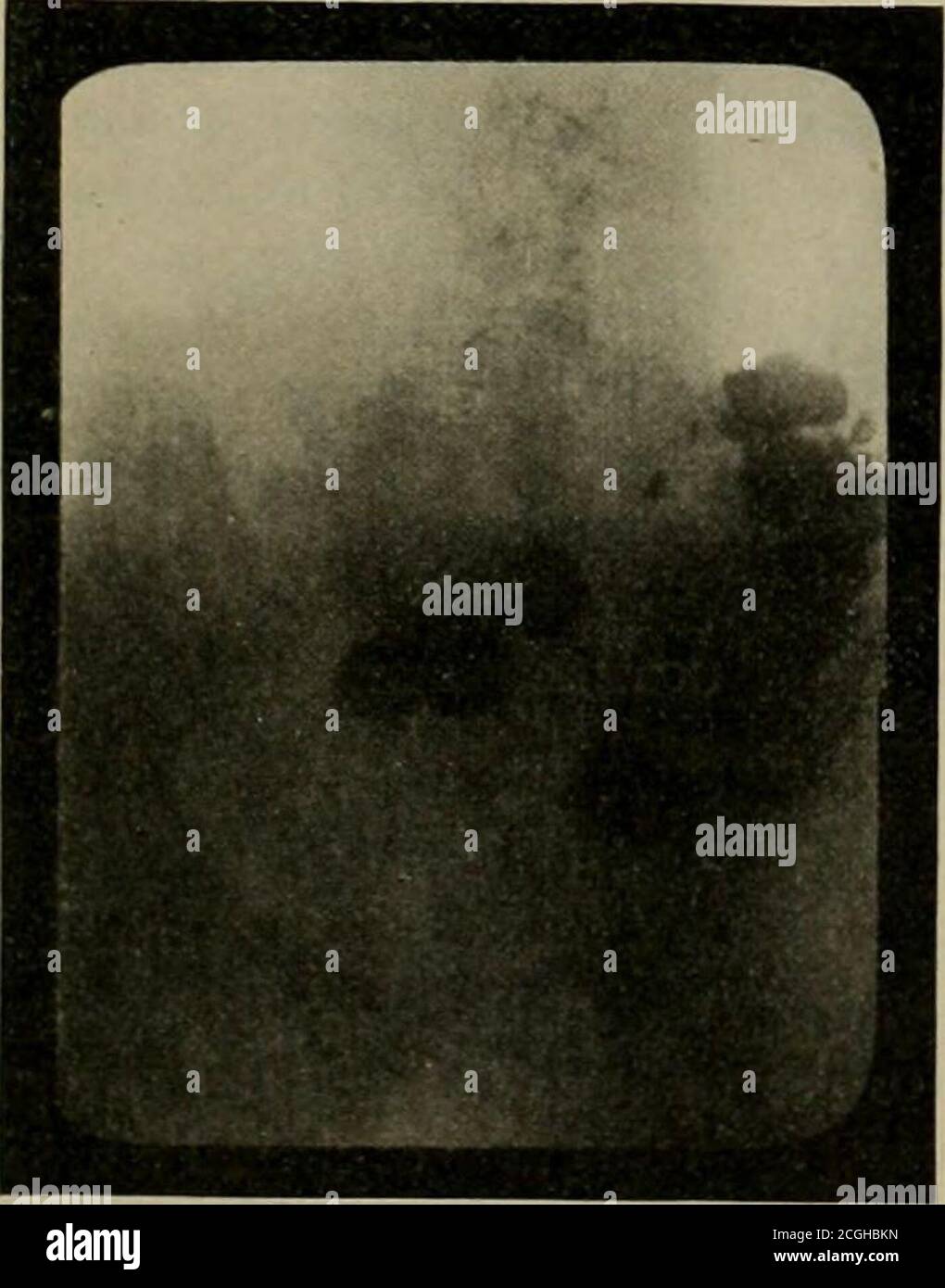 . Bollettino ospedaliero . Fig – 50 ore: Ritardo alla flessione splenica, alla stasi ileale, all'angolazione alla flessione epatica. Che se si esaminerebbe batteriologicamente il numero di feci di queste persone e si compareteli con il significato normale degli individui, si noterà. La causa primaria delle condizioni è soprattutto una questione batterica, ed è il cibo bac-terial prodotti che alla fine portano a stasi, che i chirurghi stanno cercando di rimuovere il drenaggio, ma che non può essere fatto successivamentoperché le infezioni comunemente continuano l'afteroperation. Egli pensa che il Roentgen Ray. Metodo di diagnosi Foto Stock