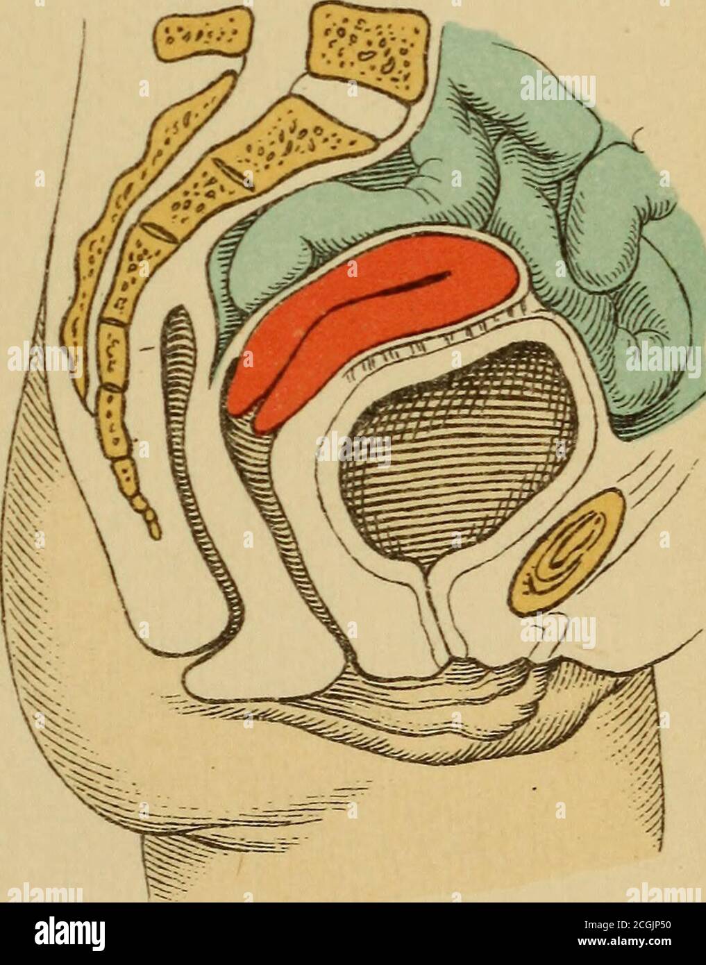 Atlante ed epitome della ginecologia . Fig. 34.-atrofia cirrotica senile  dell'ovaio.. Fig. 35.-degenerazione oligocistica dell'ovaio. Infiammazioni  dei tubi. (Fig. 36.) Questa osalpingite dell'oforo è combinata con la  peritrosalpingite, la peri-metro