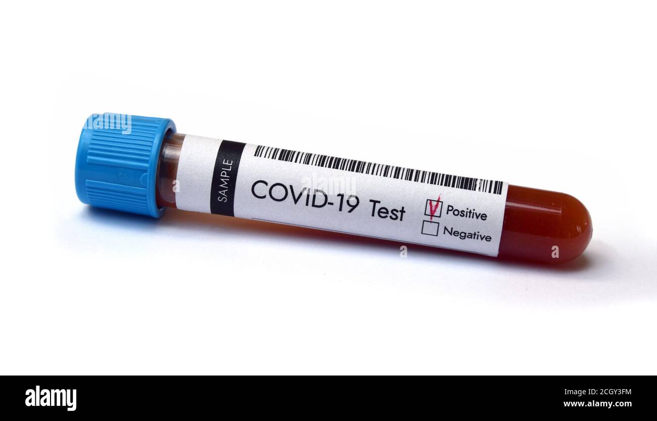 Test del coronavirus. Risultato positivo COVID-19 del campione di sangue nella provetta. Foto Stock