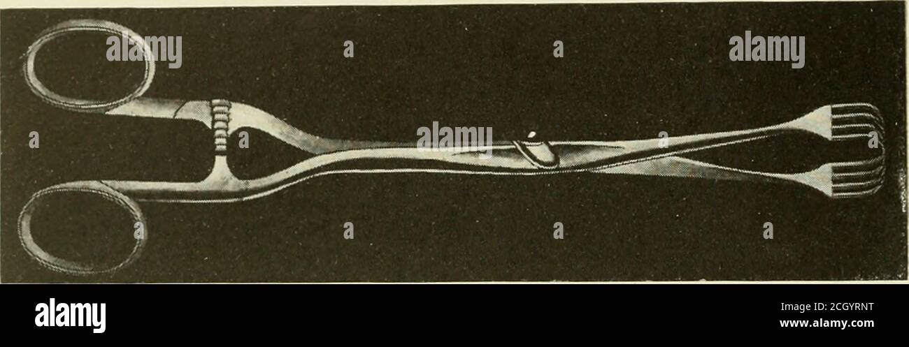 . Castrazione animale, un libro per l'uso di studenti e professionisti; . Fig. 55: Un cavo Schirrous ben sviluppato. Se alla fine di sei settimane il tumefazione persiste, l'operazione radicale, che consiste nell'ablazione totale, viene giustificata e di fatto indicata. Vincolo: Come per la castrazione di ridling, pagina 54 di sec. Posizione: Dorsale. L'anestesia generale è sempre indicata quando possibile, poiché l'intervento è estremamente doloroso e di solito prolungato per un periodo di tempo considerabile al fine di controllare l'emorragia. Strumenti, ecc.- 1. Ecraseur (figg. 5, 6, 7 e 8). 2. Aghi filettati f Foto Stock