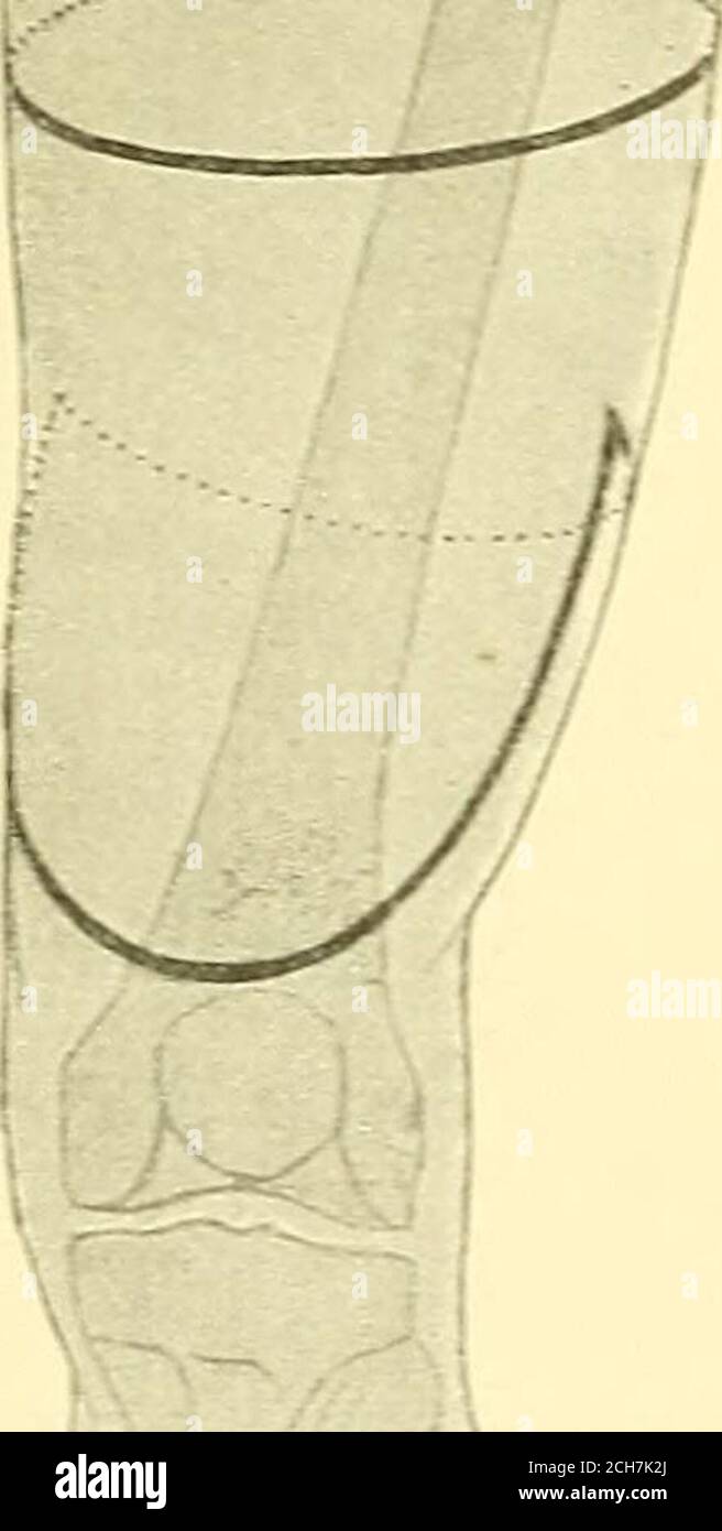 . Testo-libro di chirurgia operatoria. Ist semplicemente di pelle e fascia. Il moncone, tuttavia, è funzionalmente buono, pro-virato che l'osso è arrotondato via, che la cicatrice giace posteriormente (incisione obliqua),e che la mobilità della pelle è mantenuta coprendo sulla superficie segata dell'osso con uno strato di fascia profonda. A questo proposito le condizioni sono simili alla disarticolazione della thosein in corrispondenza del ginocchio. Nel mezzo della coscia si dovrebbe ancora tentare di procurare un adattamento di moncone per il peso del cuscinetto. Tutte le incisioni, quindi come le flapincisioni circolari e doppie, in cui la cicatrice genera Foto Stock