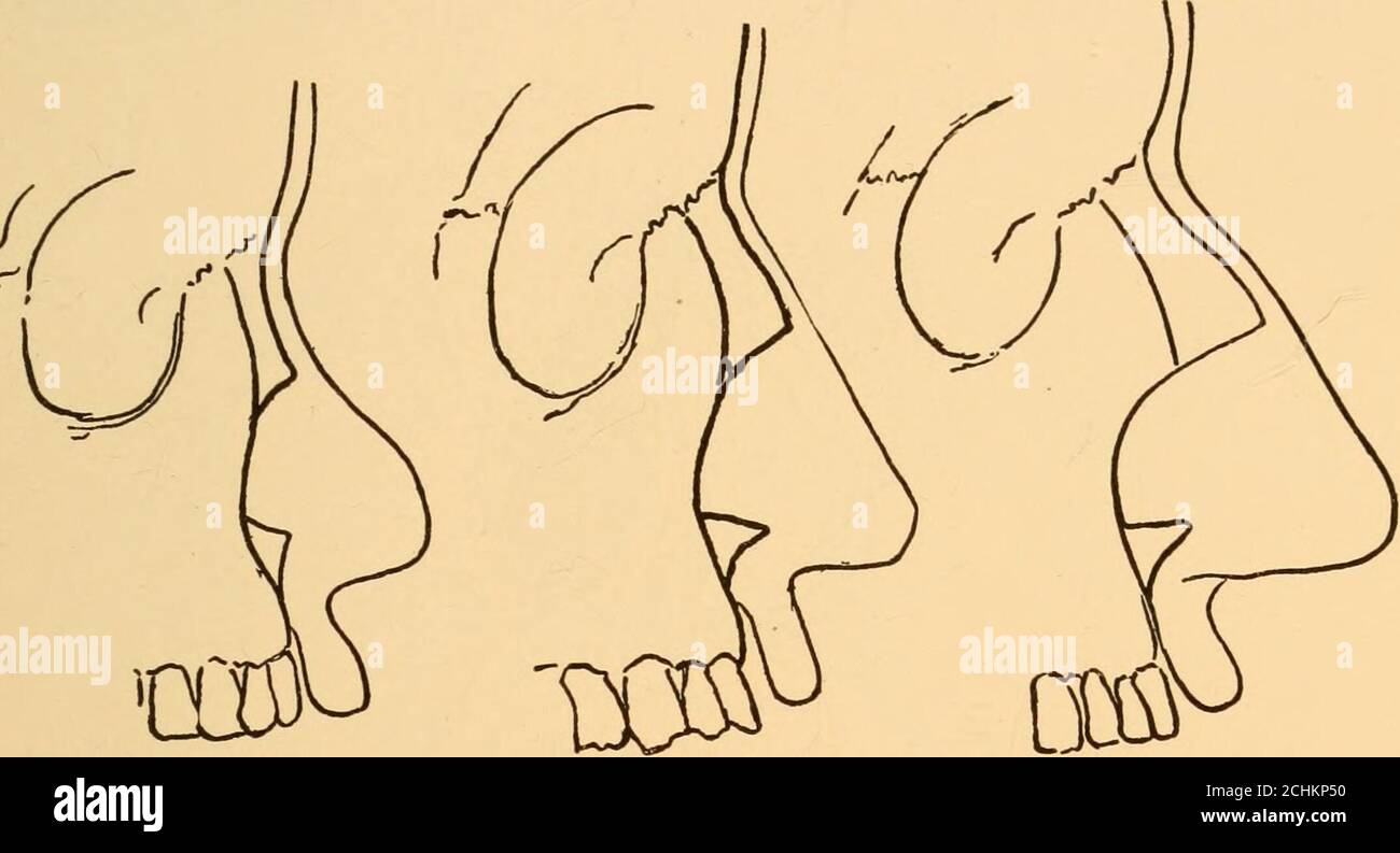 . Malattie del naso e della gola . Fig. 8.-le cartilagini laterali del naso. U, autotilagine laterale superiore; A, cartilagine alare; S, cartilagini sesamoidi; NB, osso nasale; NP,processo nasale della mascella. Di questa crescita in avanti, il suo profilo nasale può essere detto alla persistenza di bea di tipo infantile. Una simile mancanza di crescita in avanti si verifica patologicamente nei casi di atroficrinite che iniziano nella vita precoce. Se la proiezione in avanti del naso è leggera, la tibia che è supportata dalle cartilagini alari sarà ampia e L'ANATOMIA E LA FISIOLOGIA DEL NASO 37 le narici rotonde e brevetto. Più grande Foto Stock