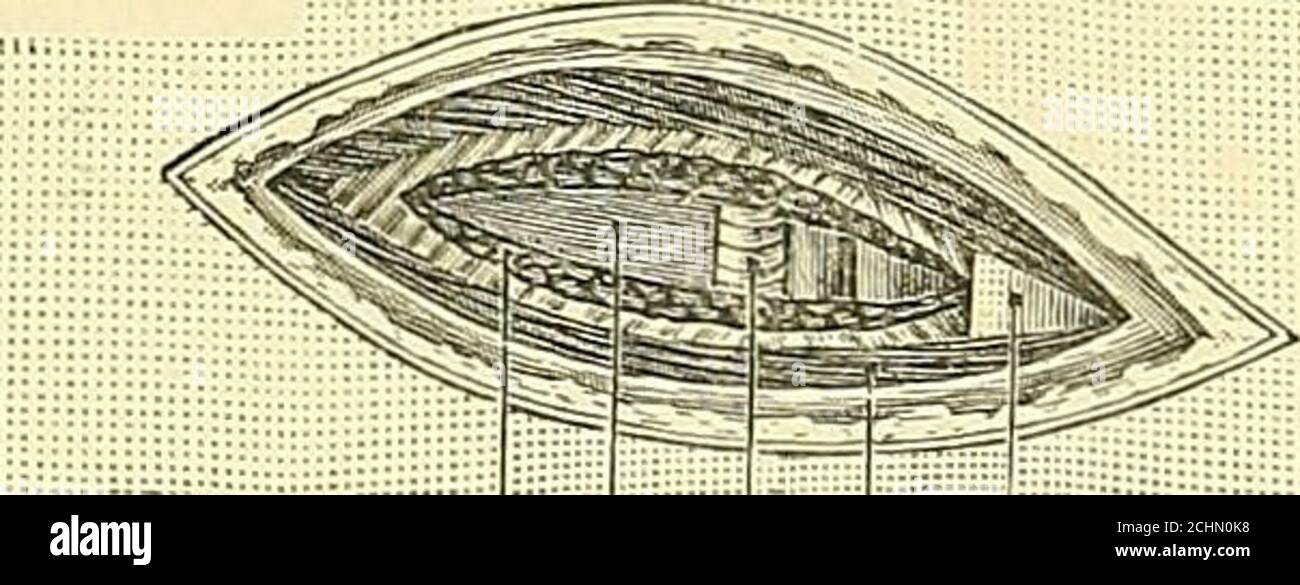 . Testo-libro di chirurgia operatoria . Es. Ant. Toracico ii.! I a.. Ascellare (I st. pari)pectoralis major vi.Dcltoid in. -J-i^ Slcnio-llivioid ;, ^^X^^^tcrno-hvoid m. 5.. Int. Iiitcrcostal DL. ; ■ Edgc di stcrnuiii pleura pectoralis viajor m. 0 Int. Ufainmarv a. Fig. 42 – legatura dell'arteria linguale sopra il cornu maggiore dell'ioide. Legatura della commoncarotide al livello della cartilagine cricoide. Legatura dell'arteria di iuuomiuato. Legatura della prima parte dell'arteria ascellare. Legatura dell'arteria mammaria interna. 114 i nervi DI CHIRURGIA OPERATORIA sono piccoli, che appaiono sotto il Foto Stock