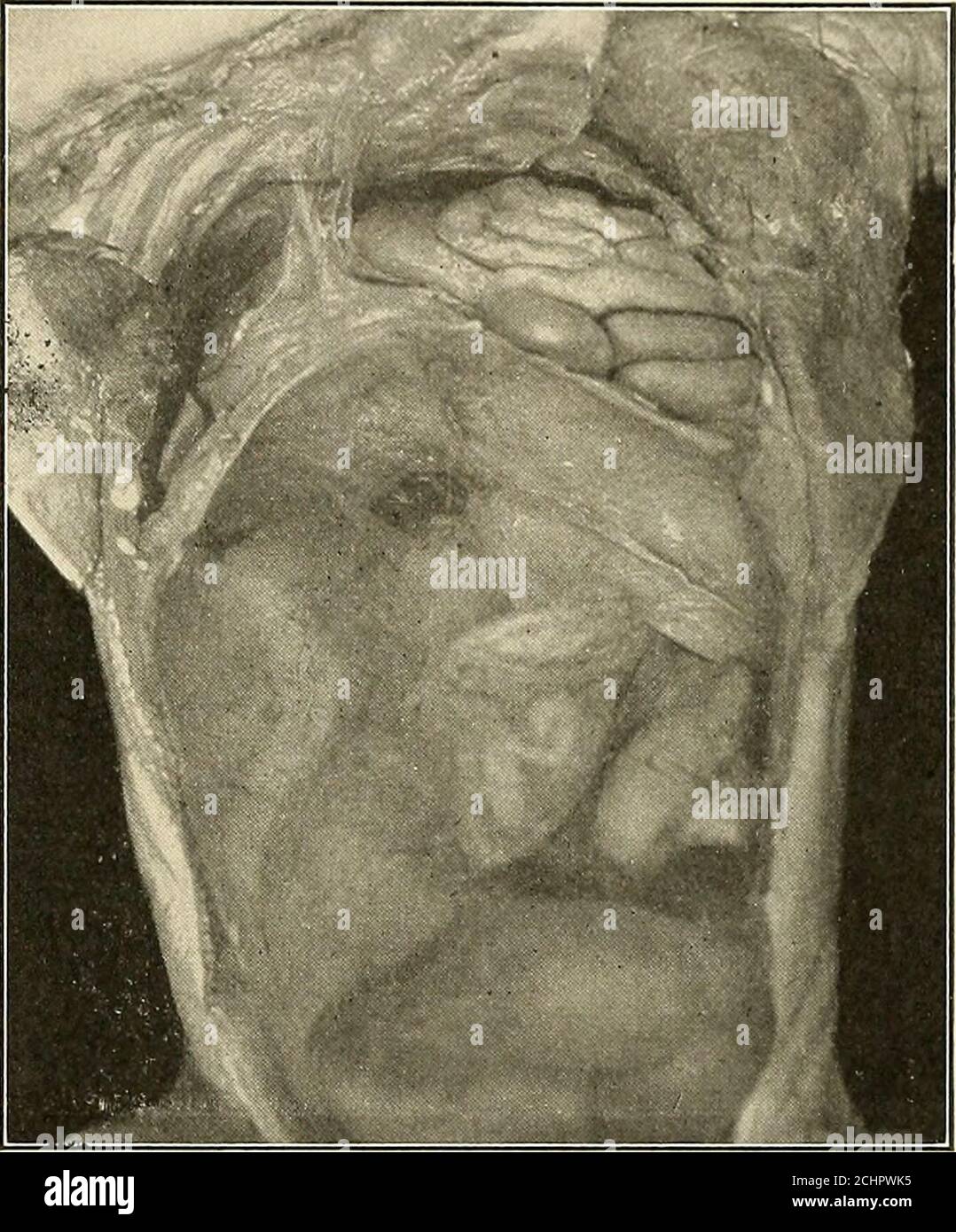 . La pratica americana della chirurgia ; un sistema completo della scienza e dell'arte della chirurgia . Colon 17 Csecum 35 intestino 133 pancreas 12 milza 78 rene sinistro 2 fegato 60 rapimento destro 1 ai^ERNIA DOMTNAL. 613 in 266 casi di ernia del diaframma in wliicli diversi organi sono stati involviviLe ha trovato che lo stomaco era nell'ernia in casi di KJl e il colon in145, mentre in casi di OS in cui un solo organo è stato coinvolto lo stomaco wsimplicated in 27, il colon in lo, il piccolo intesthie in (>, e l'omentum onlyonce. Nel caso di un trauma grave, che provoca una grande lacerazione attraverso il dia-ph Foto Stock