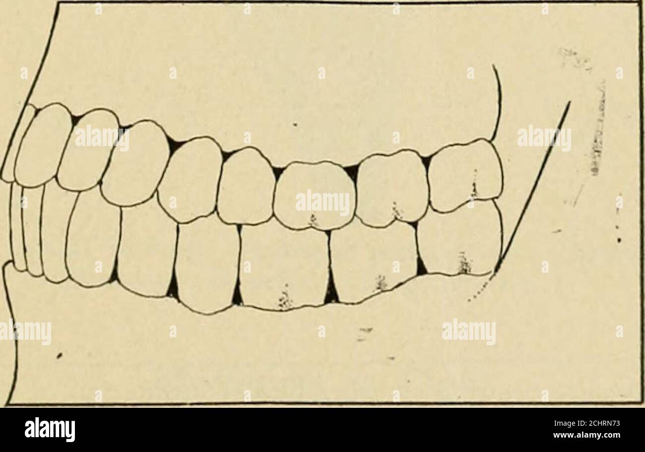 . Tecniche di anatomia operativa e dentale; un manuale di laboratorio e di aula per gli studenti di odontoiatri . Fig. 29.-secondo molare inferiore destro. Superficie occlusale. A,lobo mesio-linguale; B, lobo disto-lin-gual; C, lobo disto-buccale; D, lobo mesio-buccale; e, mesialgroove; F, solco linguale; G, distalgroove; H, scanalatura buccale. Fig. 30.-occlusione dei denti del lato sinistro. 21. Fare un disegno, vista laterale, che mostra la corretta inclinazione dei denti anteriori superiore ed inferiore (Fig. 31). Le 24 tomaie ANATOMICHE DENTALI hanno un'inclinazione labiale, le abbassate hanno un'inclinazione slightlabial o sono occasionalmente Foto Stock