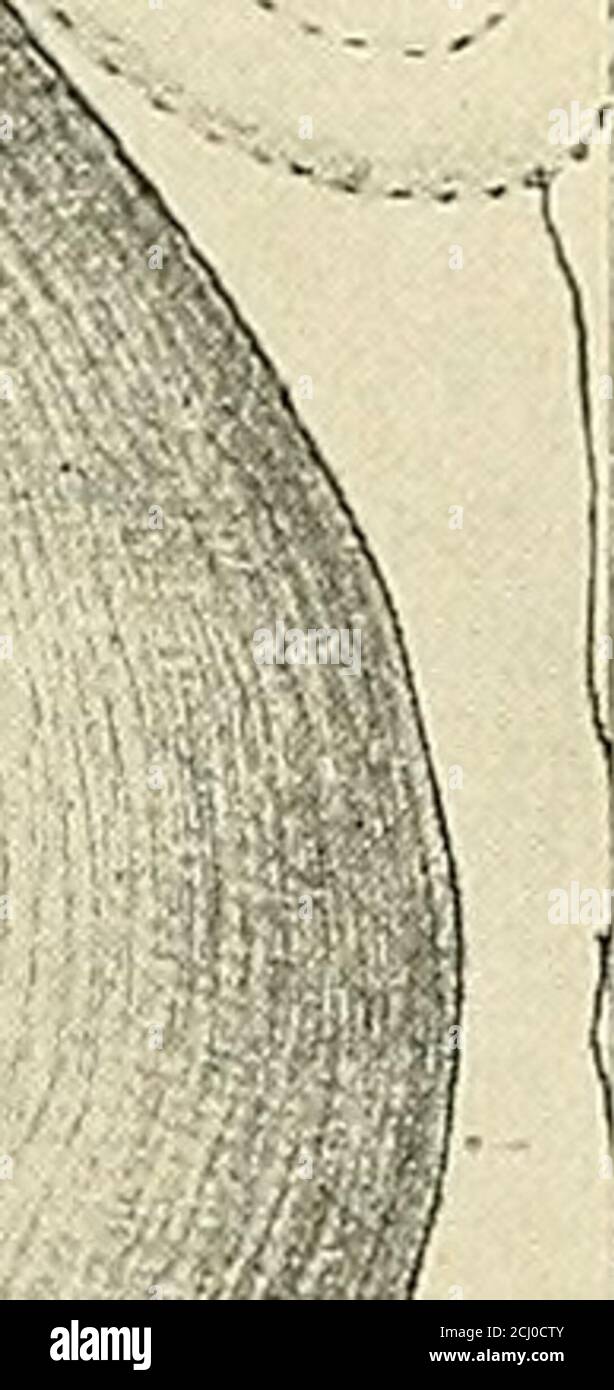 . La pratica americana della chirurgia ; un sistema completo della scienza e dell'arte della chirurgia . /, // Fig. 155.-diagramma che illustra l'operazione di Beyeas per il rilievo della gastroposi. 1, 2, 3, suture usate per accorciare questo legamento e quindi elevare lo stomaco. Modo e la cavità peritoneale viene aperta, esponendo una piccola porzione della curvatura del elessore e l'estremità cardiaca dello stomaco, il legamento gastroepatico omentor, il legamento gastro-renico, e la parte inferiore della lobedel fegato di sinistra. La tabella viene quindi elevata alla posizione Trendelenburg invertita e alla posizione st Foto Stock