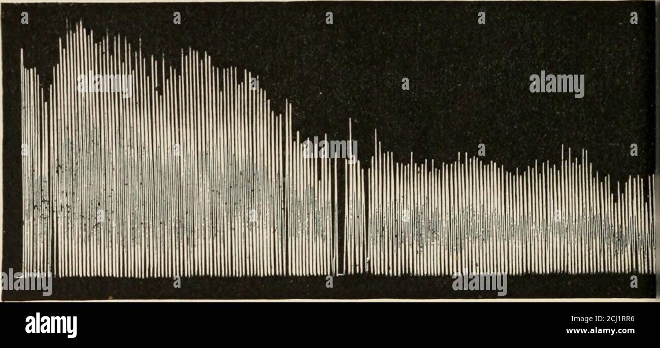 . Gli organi endocrini; un'introduzione allo studio della secrezione interna . A B FIG. 42.-A, ergografo che traccia da una persona che soffre di malattia di Addisons. B, tratto dalla stessa persona dopo sei settimane di somministrazione di suprarenale. (Langlois.) A, dimensione naturale ; B, ridotta alla metà. Sembra indicare che in queste circostanze lo zucchero è formedfrom protein, ma secondo le osservazioni di Herter e Richardsglicosuria non si verifica se il glicogeno del fegato è stato eliminato dagli effetti combinati di digiuno e floridzin iniezione. Pollak afferma, tuttavia, che nei conigli li Foto Stock