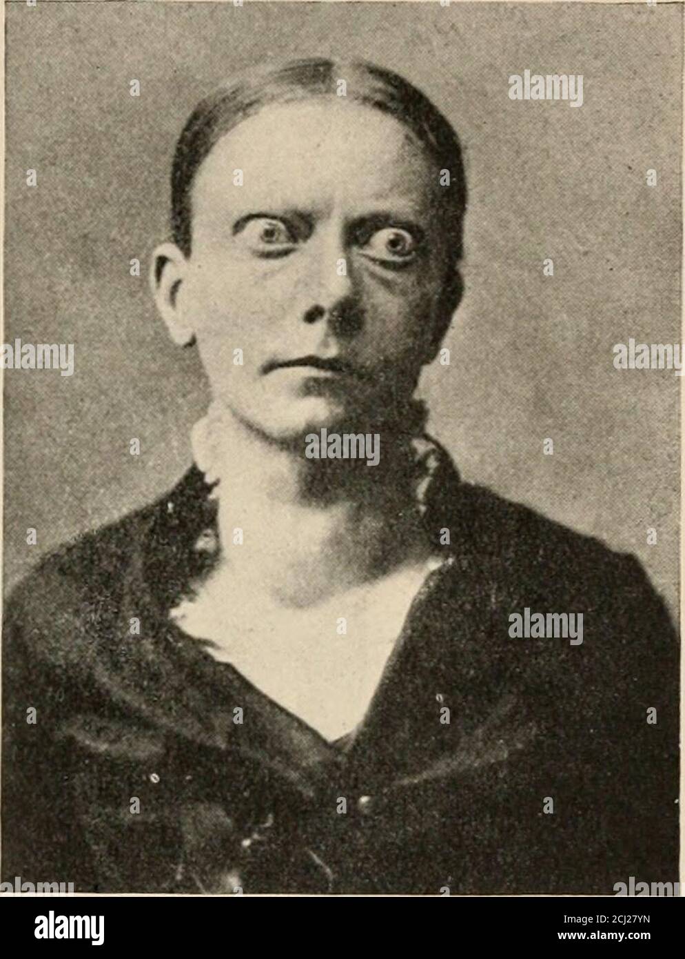 . Gli organi endocrini; un'introduzione allo studio della secrezione interna . r cent, ha una glicosuria permanente, anche se la glicosuria alimentare non è rara.Albummuria è presente in circa 11 per cento. Le apparenze istologiche (figg. 26, 27) sono conformabili con la teoria di una ipersecrezione. La ghiandola è molto allargata, e le vescicole individuali sono irregolari e tendono a correre insieme. Il tessuto interstiziale è aumentato in quantità e assume un aspetto linfoide, alcune volte con i centri germinali caratteristici. La parete del follicolo tende a crescere all'interno del follicolo Unito Foto Stock