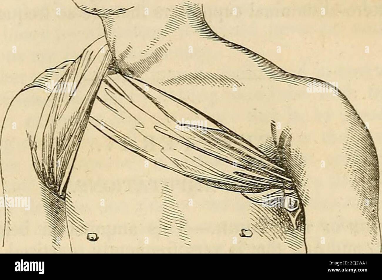 . I principi e la pratica della moderna chirurgia . [O il bendaggio triangolare di Velpeau fa un molto pulito e semplicedressing per l'inguine. È costituito da un pezzo di mussola triangolare, da una fascia di havinga attaccata alla sua base, allo scopo di fissarla intorno alla vita, e da un'altra striscia fissata al suo apice, che passa intorno alla parte superiore della coscia, come nella figura allegata.- ed.] XIII. Per l'ascella. – per tenere su medicazioni o poulture, & c., mettere il centro di un comune fazzoletto piegato ad angolo sotto Bai^DAGES. 533 l'ascella, la attraversa sulla spalla e porta le estremità Foto Stock
