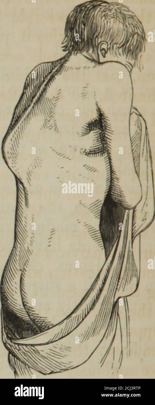 . I principi della chirurgia . FIE. 130. gettato fuori, e una base sana per la riparazione ottenuto. Ciò può essere compiuto con uno sforzo della parte stessa; ulcerationsgretolando giù la parte cariosa e innaturalmente cancellata e lasciandoil tessuto normale circostante unattaced; cessando quando comesthere, il relativo compito essendo stato compiuto e dando posto allo sforzo reparativo già là cominciato. O l'ulcerazione forse accelerata, o tutti gli eventi mescolati con più deathof continuo la parte non redditizia: La necrosi. Tale processo distruttivo, specialmente quella ulcerazione biterare, ma Foto Stock