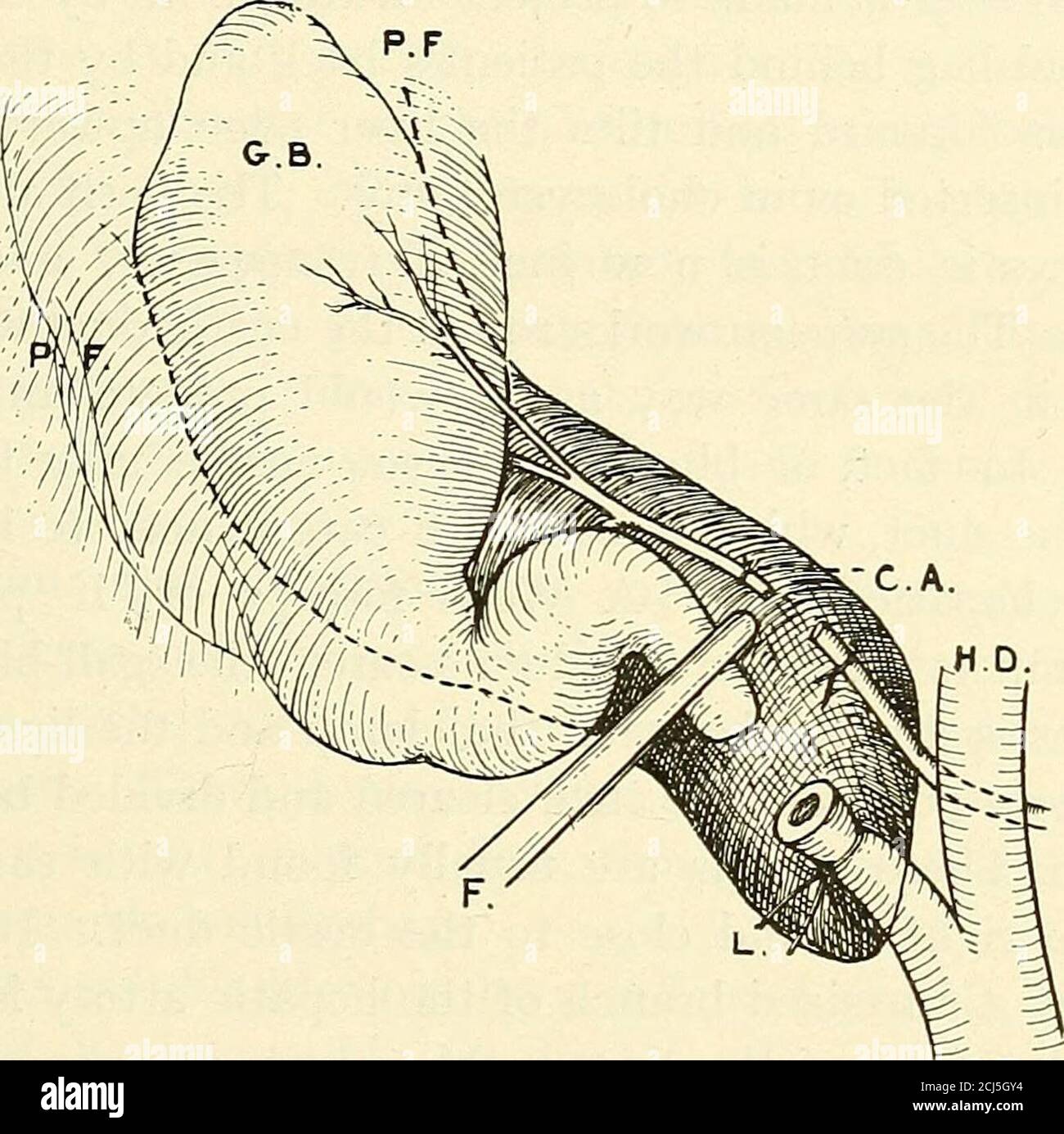 . Un manuale di chirurgia operatoria. Inflam- mazione delle sue pareti. 6. Lunga persistenza di una fistola biliare dopo il drenaggio. Ciò può tuttavia indicare un'altra pietra nel dotto biliare del thecomon, che richiederà la rimozione.UNA nuova crescita (adeno-carcinoma), limitata alla cistifellea,è un'indicazione evidente per colecistectomia, ma tali casesare molto rari. Abbiamo escisso la cistifellea con un pezzo di fegato a forma di cuneo sopra di essa in un caso in cui la colecistectomia infil- * previene il rischio di cancro della cistifellea a seguito, a intervalli considerevoli, di rimozione di calcoli biliari. Questo rischio, Foto Stock