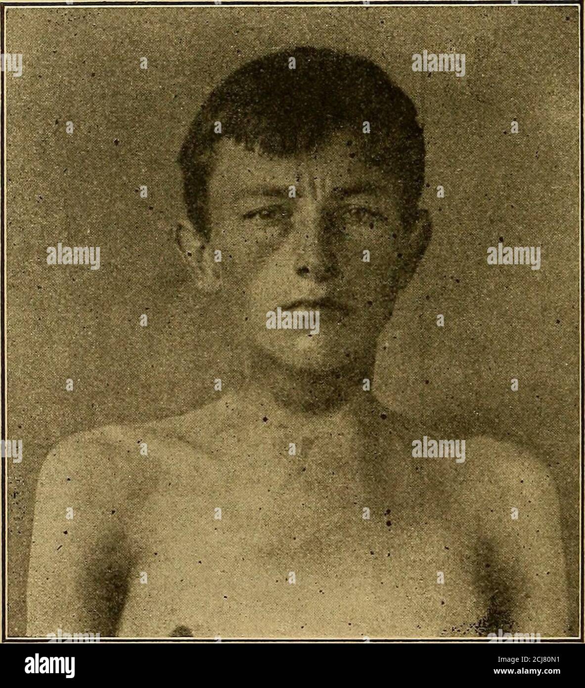 . Diagnosi fisica. T di tutte le malattie del torace-phthisis. Si osserva anche in alcune varietà di cardiopatia. Pallore delle mucose, come si vede nelle labbra e congiuntivae, è molto più adatto ad essere un segno di anemia reale che ispallore della pelle. Nel migliore dei casi, il pallore è solo un segno che suggerisce di guardare più avanti nel caso in una o in un'altra direzione, e di per sé non dimostra nulla di importante. (4) ittero.la tinta giallastra che compare nella pelle, e specialmente in 94 DIAGNOSI FISICA.le congiuntivae, quando la fuga della bile dal fegato è ostacolata,è a volte b Foto Stock