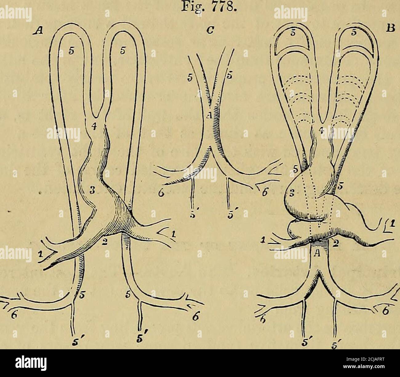 . Elementi di anatomia di Quain. Ad una grande dimensione insieme con la crescita della teplacenta. Man mano che si formano gli arti, si sviluppano le arterie che diventano poi le divisioni iliache dell'aorta principale; ma theyare per lungo tempo relativamente piccolo, mentre le arterie ombelicali areof grandissima dimensione, in modo che, fino alla conclusione della vita fetale, theselast sembrano formare la parte principale dei due grandi vasi in cui l'aorta si divide. Relazione TTE del processo di fusione mesiale dell'aorta originariamente doppia al verificarsi di un doppio canale permanente in quel vaso come m Foto Stock