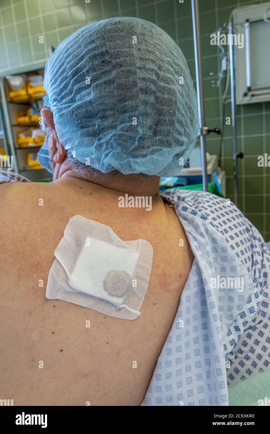 un paziente ha un grande ascesso sulla sua schiena Foto Stock