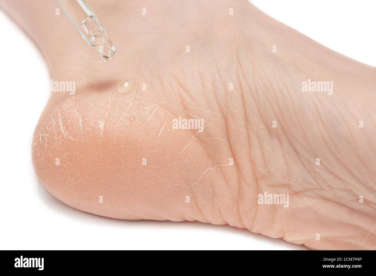 Primo piano del piede femminile, tallone con pelle secca, molto incrinata e crepe. Dermatologia, medicina, cosmetica concetto piedi umani Foto Stock
