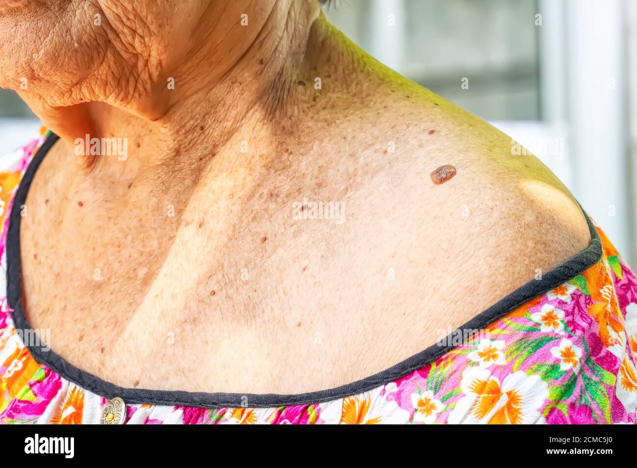 Tag di pelle o acrochondon o soft fibroma è una cassetta di sicurezza. Essa non hanno effetto sul corpo. Di solito avviene presso il collo, il viso, le ascelle e il corpo. Foto Stock