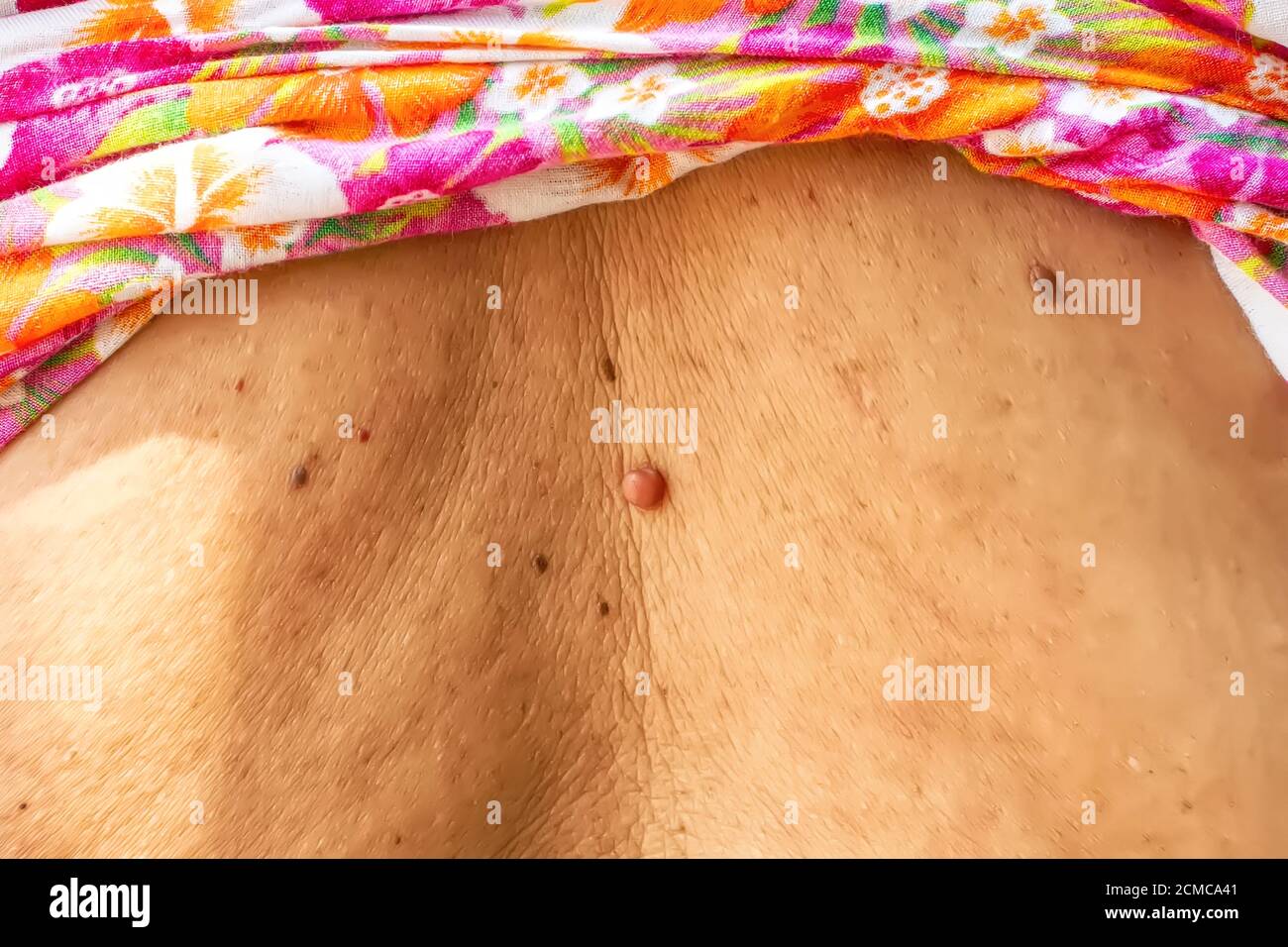 Tag di pelle o acrochondon o soft fibroma è una cassetta di sicurezza. Essa non hanno effetto sul corpo. Di solito avviene presso il collo, il viso, le ascelle e il corpo. Foto Stock