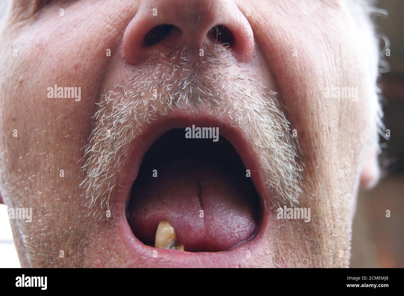 La bocca con denti cariati Foto Stock