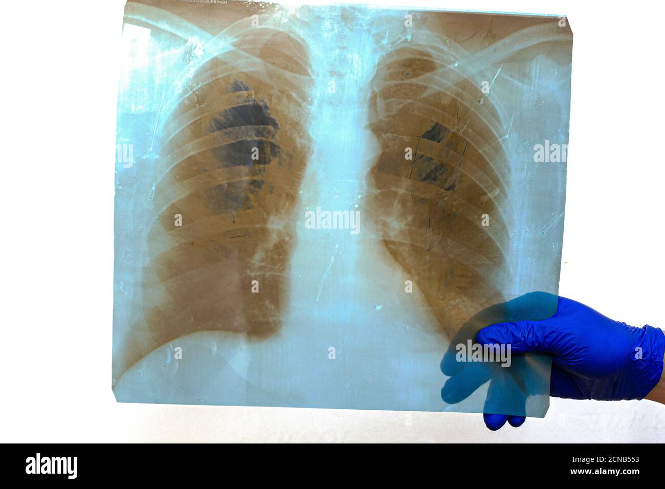 mano in gomma blu guanto chirurgico medico protettivo per la custodia dei raggi x dei polmoni umani Foto Stock