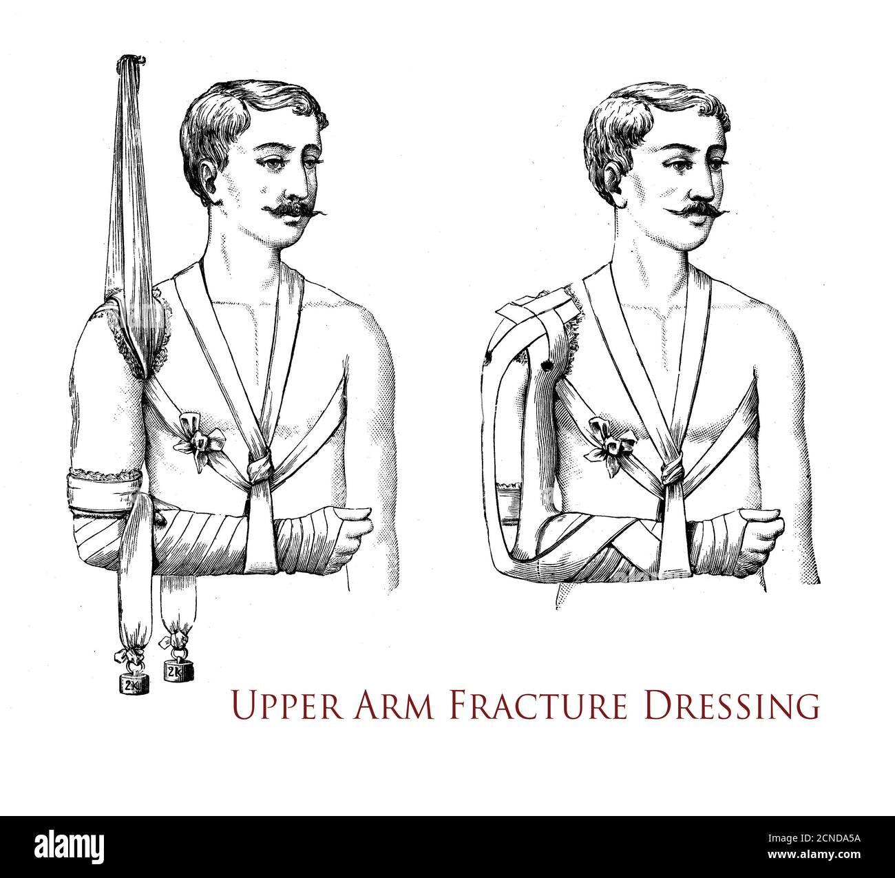 Sanità e medicina: Disegno che spiega come eseguire una medicazione per frattura del braccio superiore, illustrazione vintage Foto Stock