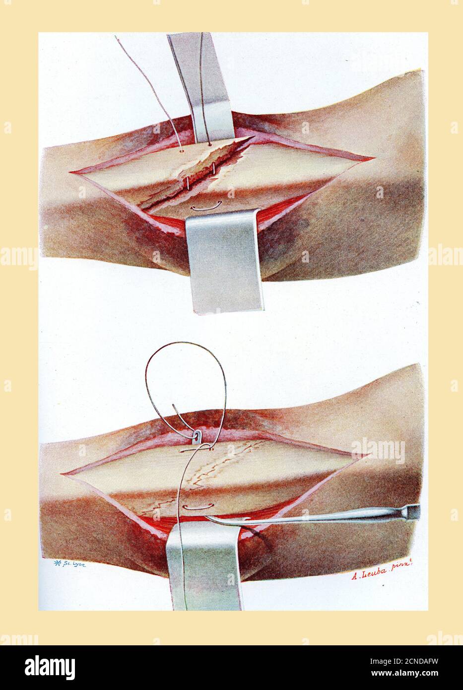 Sanità e medicina: Disegno che spiega come eseguire una sutura ossea per una tibia fratturata, illustrazione a colori vintage Foto Stock