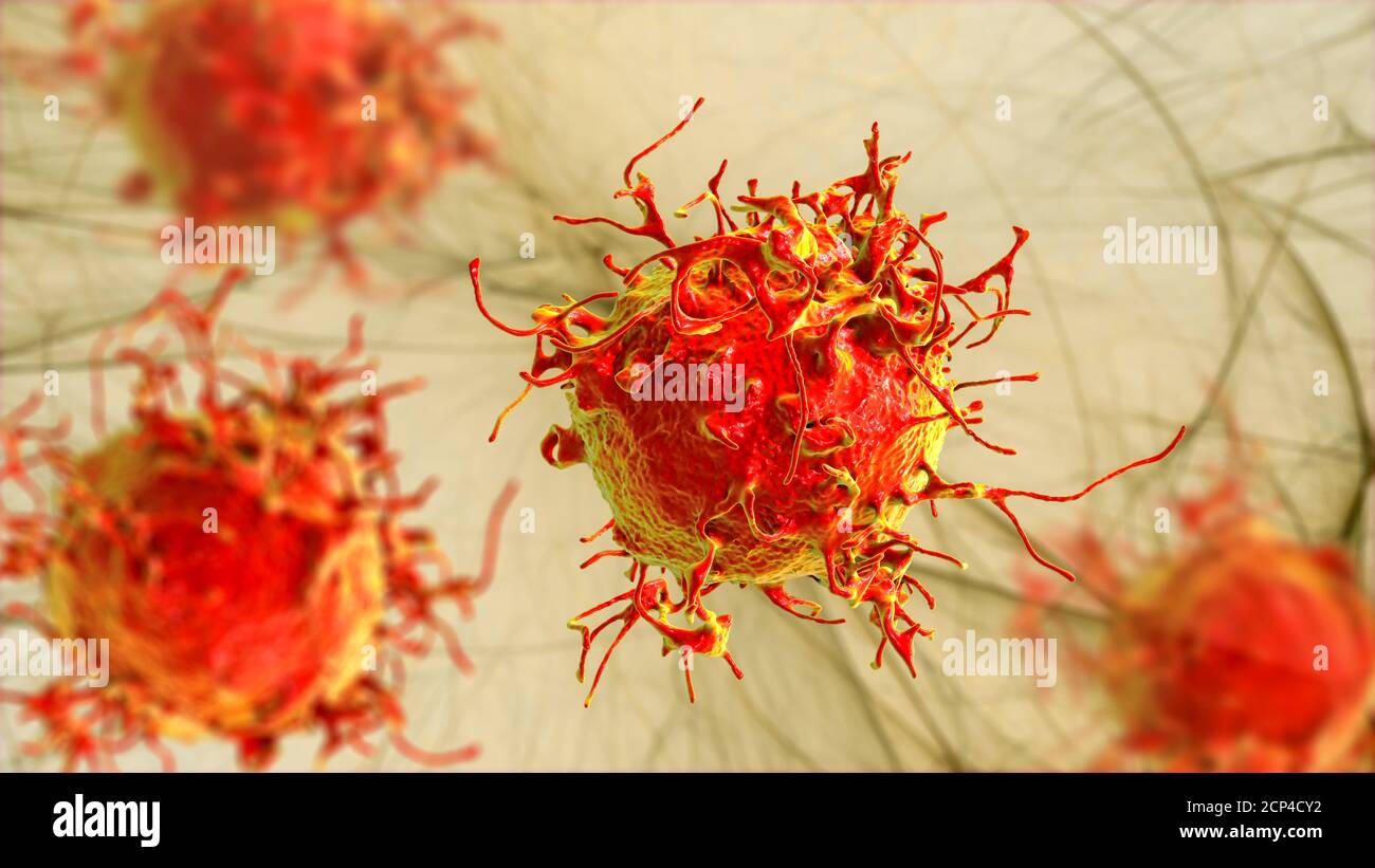 Cellula di cancro della pelle, illustrazione del calcolatore. Foto Stock