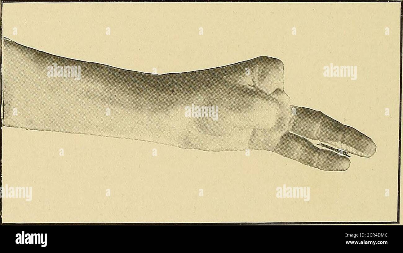 . Chirurgia ferroviaria : un manuale sulla gestione delle lesioni . FIG. 60.-Falanx di Thumb rimanente e trattato unendo il flessore e tendini esten-sor sull'estremità della pelle di moncone. Alcune suture possono essere inserite in punti in cui è necessario trattenere i lembi nelle loro nuove relazioni, lasciando plentyof scappatoie per il libero drenaggio (vedi Fig. 58).. Fig. 61.-che mostra la libertà di movimento raggiunta nel caso illustrato in Fig. 60. Dopo che le parti sono state puril)7 lavate con soluzione di bi-cloruro, ed è stata utilizzata molta acqua calda,una medicazione solida costituita da molti spessori di garza IN Foto Stock