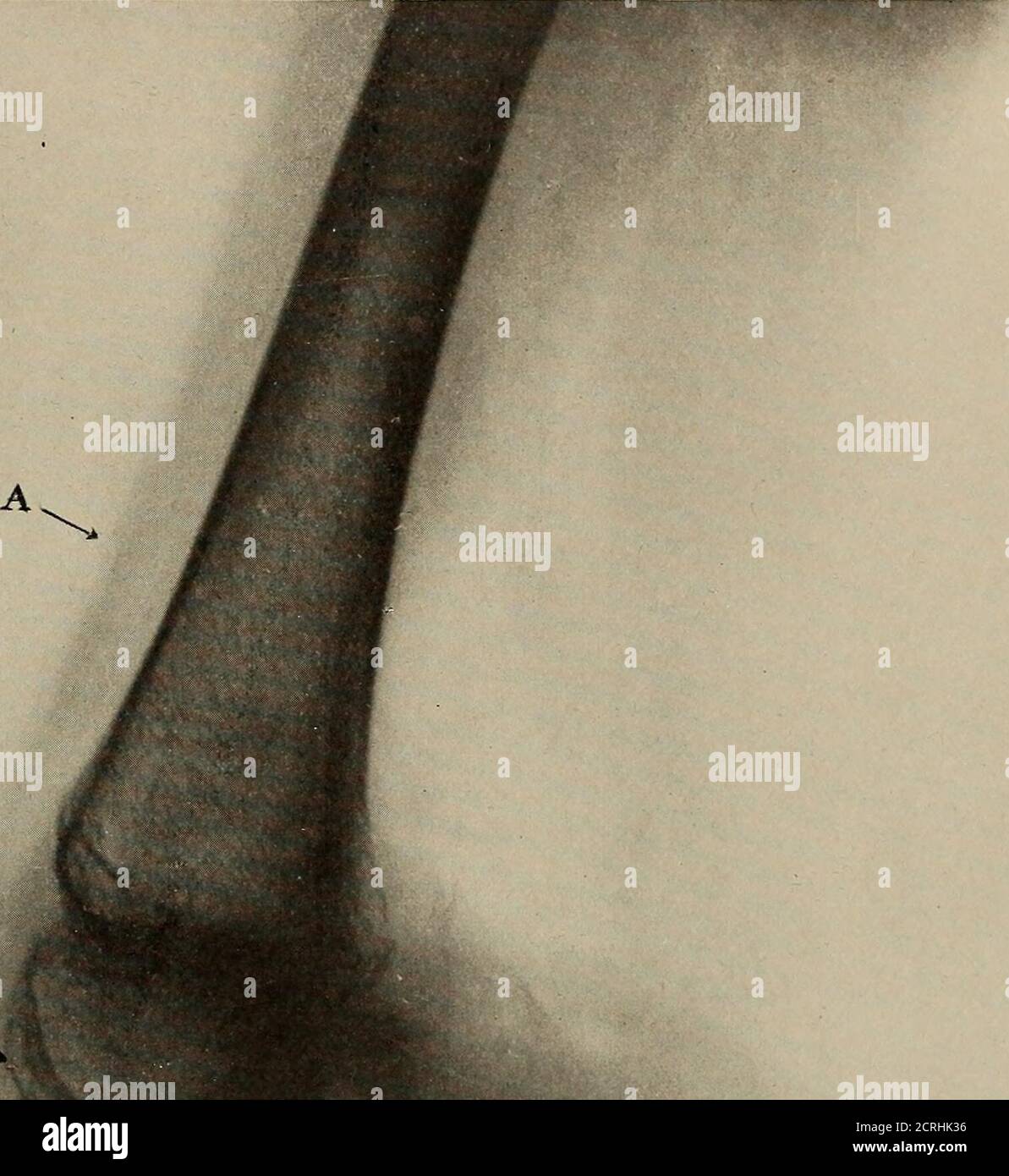 . Anatomia e patologia vivente; . PIASTRA 234. ARTRITE INFETTIVA DELL'ARTICOLAZIONE DEL GINOCCHIO, CHE MOSTRA UNA CONDIZIONE ATROFICA ACHRONIC. (Stesso soggetto della piastra 233.) (Dimensioni vita). A. indica il profilo matiled marcato del femore a causa dell'osso corticale molto denso. B. le superfici articolari irruvidite del femore, a causa di una certa erosione delle superfici articolari. C. indica l'area della rotula scarsamente sviluppata. Piastra 234 B. Foto Stock