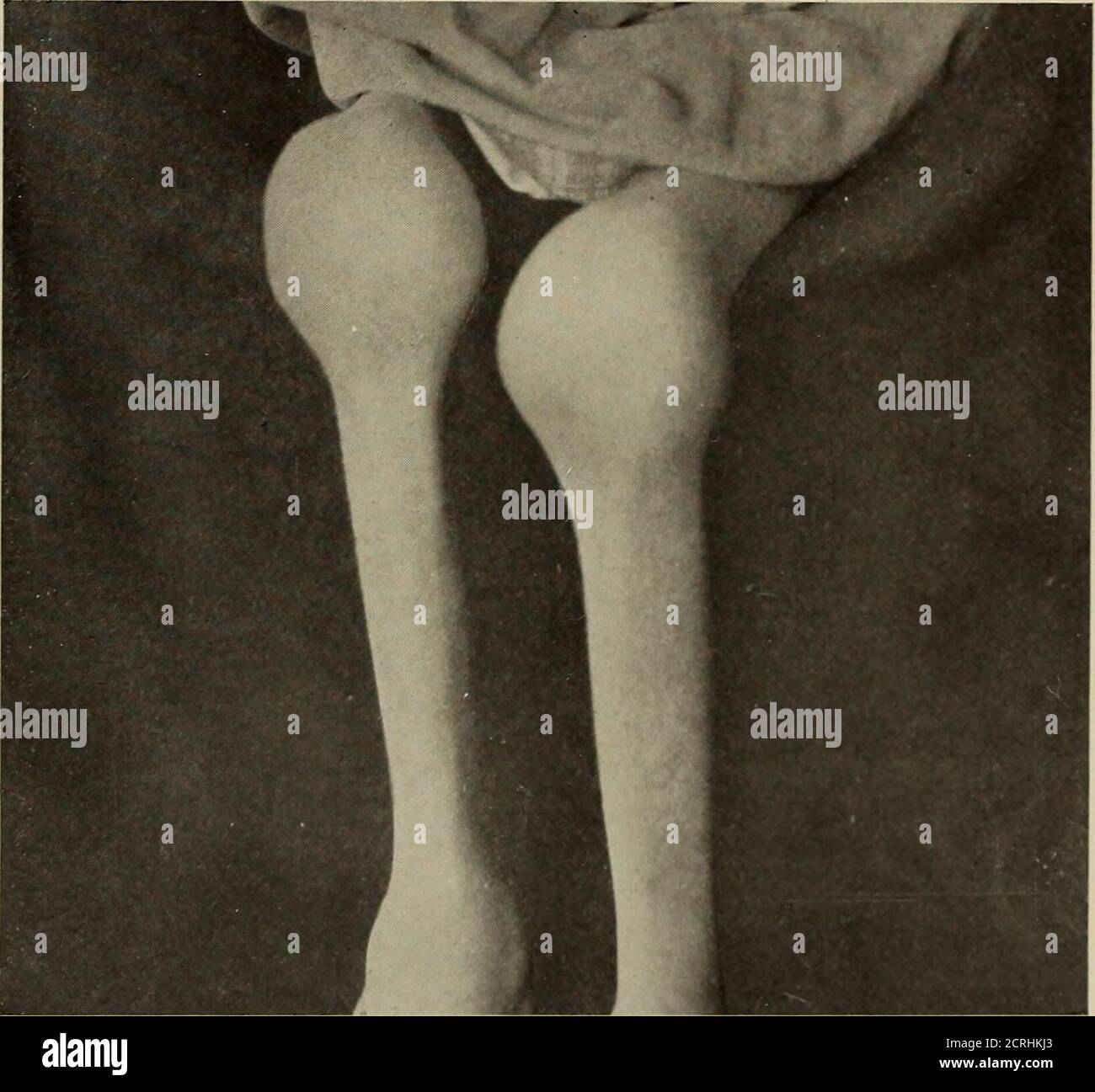 . Anatomia e patologia vivente; . PIASTRA 233.CONDIZIONE ATROFICA CRONICA DELLE ARTICOLAZIONI DEL GINOCCHIO. Ragazzo, 8 anni. Fotografia dello stesso soggetto della piastra 234. Piastra 233. PIASTRA 234. ARTRITE INFETTIVA DELL'ARTICOLAZIONE DEL GINOCCHIO, CHE MOSTRA UNA CONDIZIONE ATROFICA ACHRONIC. (Stesso soggetto della piastra 233.) (Dimensioni vita). A. indica il profilo matiled marcato del femore a causa dell'osso corticale molto denso. B. le superfici articolari irruvidite del femore, a causa di una certa erosione delle superfici articolari. C. indica l'area della rotula scarsamente sviluppata. Piastra 234 B Foto Stock