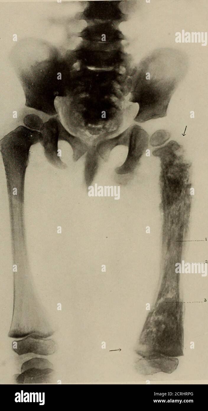. Anatomia e patologia vivente; . Piastra 214 1 i PIASTRA 215. OSTEOMIELITE CRONICA: GRANDE DISTRUZIONE DEL FEMORE. Età 2 anni. (Stesso soggetto della piastra 214. Preso 5 settimane dopo.) 1. Un'area di suppurazione. 2. Osso periosteo di nuova formazione. 3. Osso corticale necrotico. Le frecce mostrano i punti di attacco della capsula eperiosteo. Il gambo del femore, l'anca e le articolazioni del ginocchio non sono coinvolti; l'infezione è confinata all'interno di dellimit del periosteo. Piastra 215. PIASTRA 216.OSTEOMIELITE DEL GOMITO. Ragazzo, 9 anni. (Dimensioni vita). Mostra una notevole distruzione con la nuova formazione di bonew Foto Stock