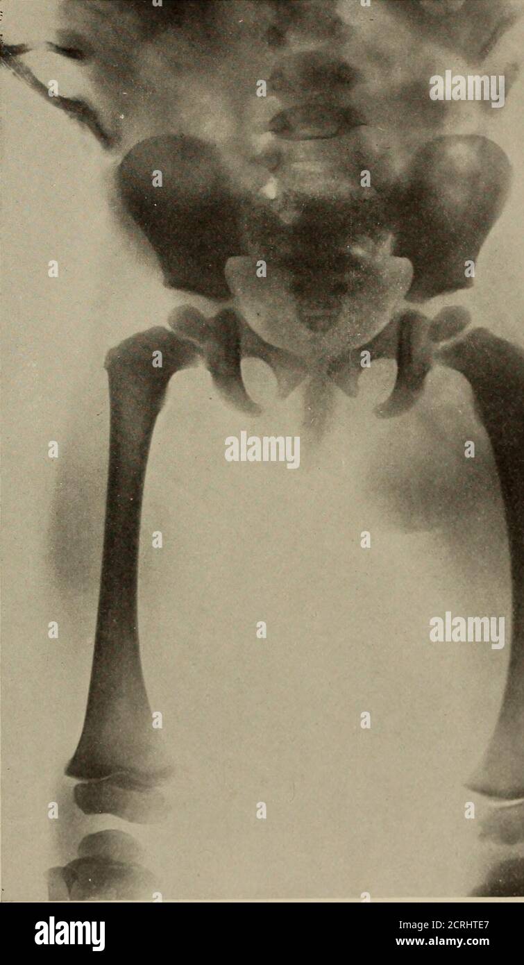 . Anatomia e patologia vivente; . PIASTRA 214.OSTEOMIELITE ACUTA DEL FEMORE DESTRO. Bambino, 2 anni Jears. (Stesso soggetto della piastra 215.) Mostra un'area di ridotta radiabilità del subcutaneoustissue e gonfiore dei muscoli della gamba destra. L'outline dell'osso è pigro. La corteccia non è così ben definita come normale.Nessun disturbo delle epifisi. Piastra 214 1 i PIASTRA 215. OSTEOMIELITE CRONICA: GRANDE DISTRUZIONE DEL FEMORE. Età 2 anni. (Stesso soggetto della piastra 214. Preso 5 settimane dopo.) 1. Un'area di suppurazione. 2. Osso periosteo di nuova formazione. 3. Osso corticale necrotico. Le frecce sh Foto Stock