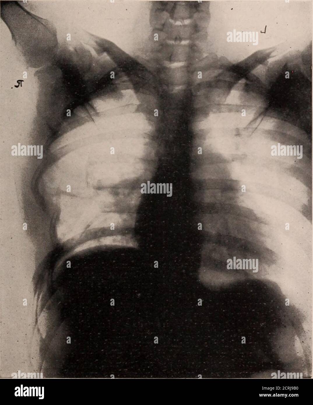 . Giornale di radiologia . Figura III.-ispezione della cavità, che mostra- apertura bronchia1. Obliteranti dell'endarterite e infine la formazione di tessuti connettivi densi. Alterazioni delle strutture patologiche:il tessuto linfoide normale è meno sensibile alla radio rispetto ai vari tipi di hy-. Flgure IV. - quattro settimane dopo l'uso. Piccolo residuo di massa tumorale e parete tumorale molto sottile. Perplasie, infezioni bacillari, lym-fomi e sarcomi. La disinvoltura e i linfosarcomi di Hodgkins sono estremamente sensibili alla radio e ingrossati spleensretrattili alla dimensione normale sotto l'influenza radiologica e radiologica. I cambiamenti nelle cellule tumorali w Foto Stock