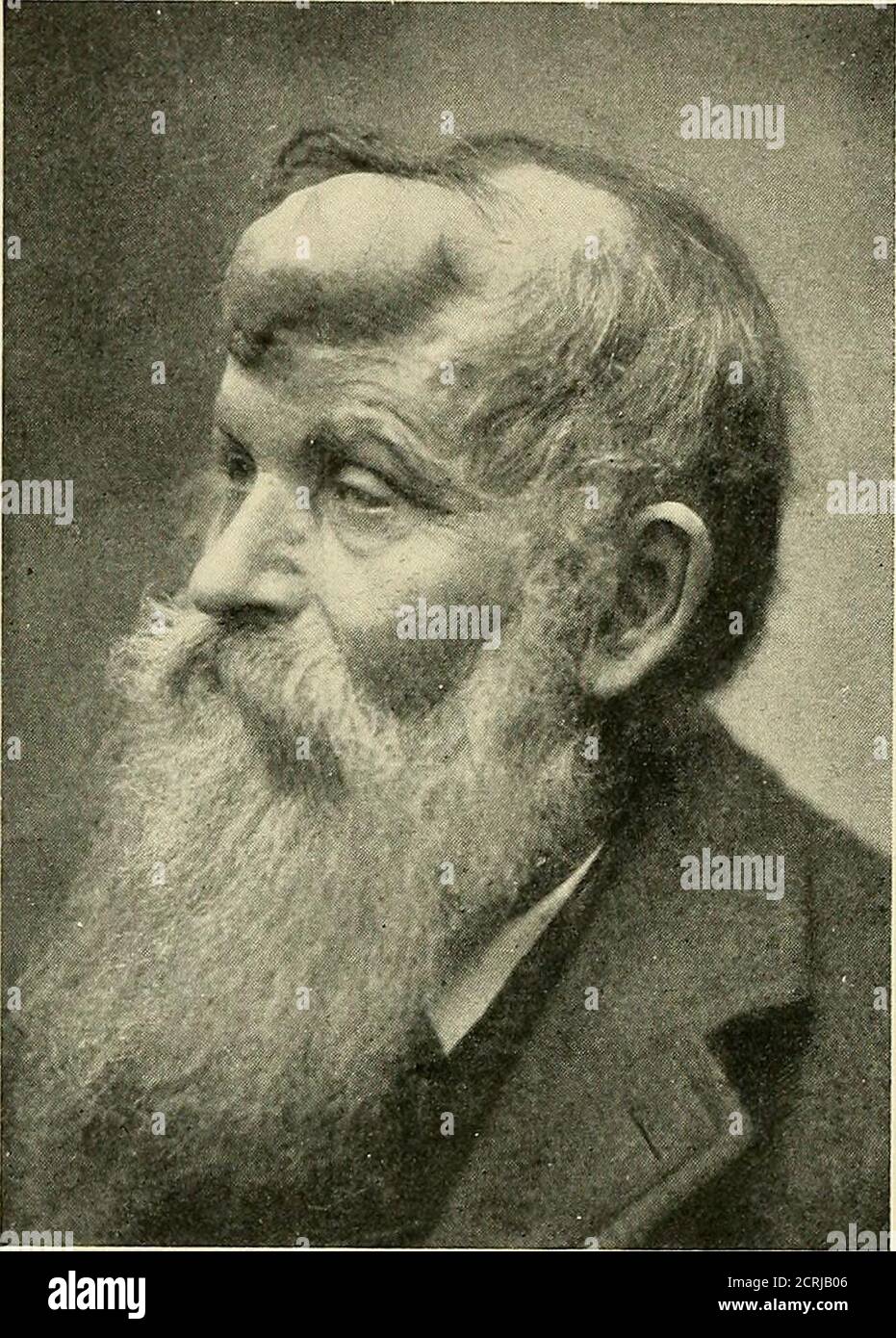 . Diagnosi a raggi Röntgen e terapia . fino gode di perfettealth.) Fig. 296 rappresenta un'acounterpart in questo caso.illustra un glioma, che ha richiesto l'enucle-azione del bulbo oculare in agirl di due anni. Evenin questo disperato casegreo miglioramento temporaneo in una fase tardiva è stato osservato. Fig. 297 illustra l'osteosarcoma del cranio in un uomo di sessantasei anni. Una skiagraph ottenuta mostrava poi l'arrosion dell'osso frontale. Estirpazione estesa è stata eseguita dal theauthor all'ospedale di St. Marks. L'esame microscopico è un sarcoma a cellule rotonde di tipo ordinario (Fig. 298).dopo r Foto Stock