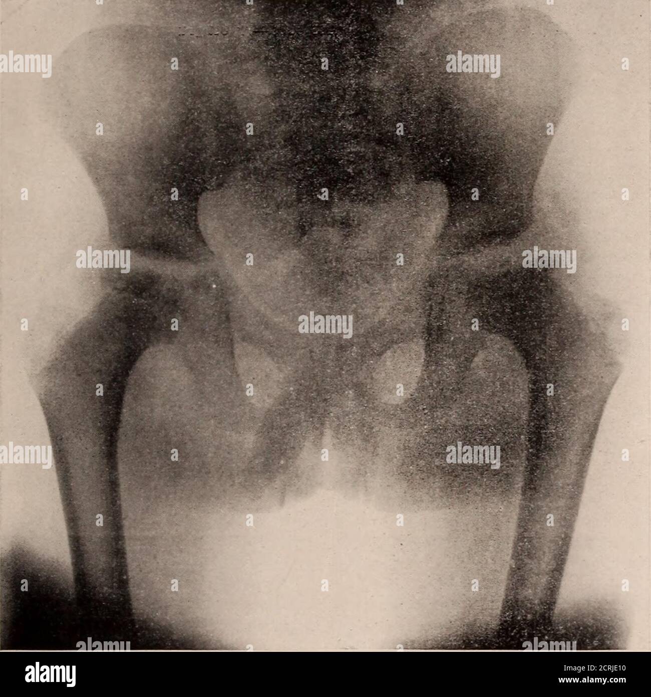. Giornale di radiologia . Fig-ure II - caso II. 262 Figura III - caso III - stesso caso di Figura II, nove mesi dopo. UNO STUDIO SULLA MALATTIA DI LEGGS: GILES. Figura IV - caso II - lo stesso caso mostrato nel progresso della malattia è da sei a dodici mesi, con un abbotto di sintomi dopo uno a due anni. Il recupero avviene con un giunto rimodellato, ma con un'eccellente funzione. Dopo che i sintomi sono stati spaventati vi rimane solo una leggera ri-strizione del movimento, e le caratteris- Fig-sono 3, tre mesi più tardi. tic x-ray rilevamenti per identificare il process.ankylosis, limitata flessione, e li Foto Stock