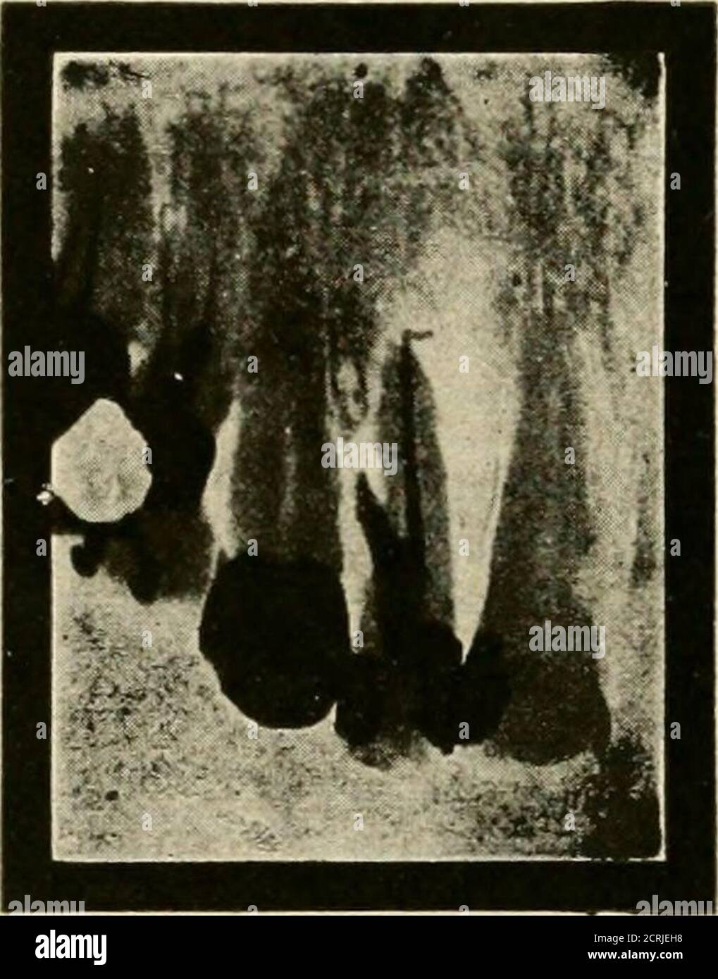 . Radiografia elementare e dentale / di Howard Riley Raper. 184 il filo che raggiunge il punto di sensibilità non raggiunge il teapice, dimostrando che la sensibilità è causata da un residuo di pasta non rimosso, non vitalizzato. Smettiamola di considerare come questa domanda di se arriviamo o meno all'apice è decisa quando le radiografie non sono usate. Noi pumpfenolo o qualche altro ottundent nel canale, lavorando la nostra broccia più lontano 1*4 RADIOGRAFIA DENTALE e più lontano fino a colpire la fine del canale che termina in un vicolo cieco, orgo finora nei tessuti apicali che conosciamo Foto Stock