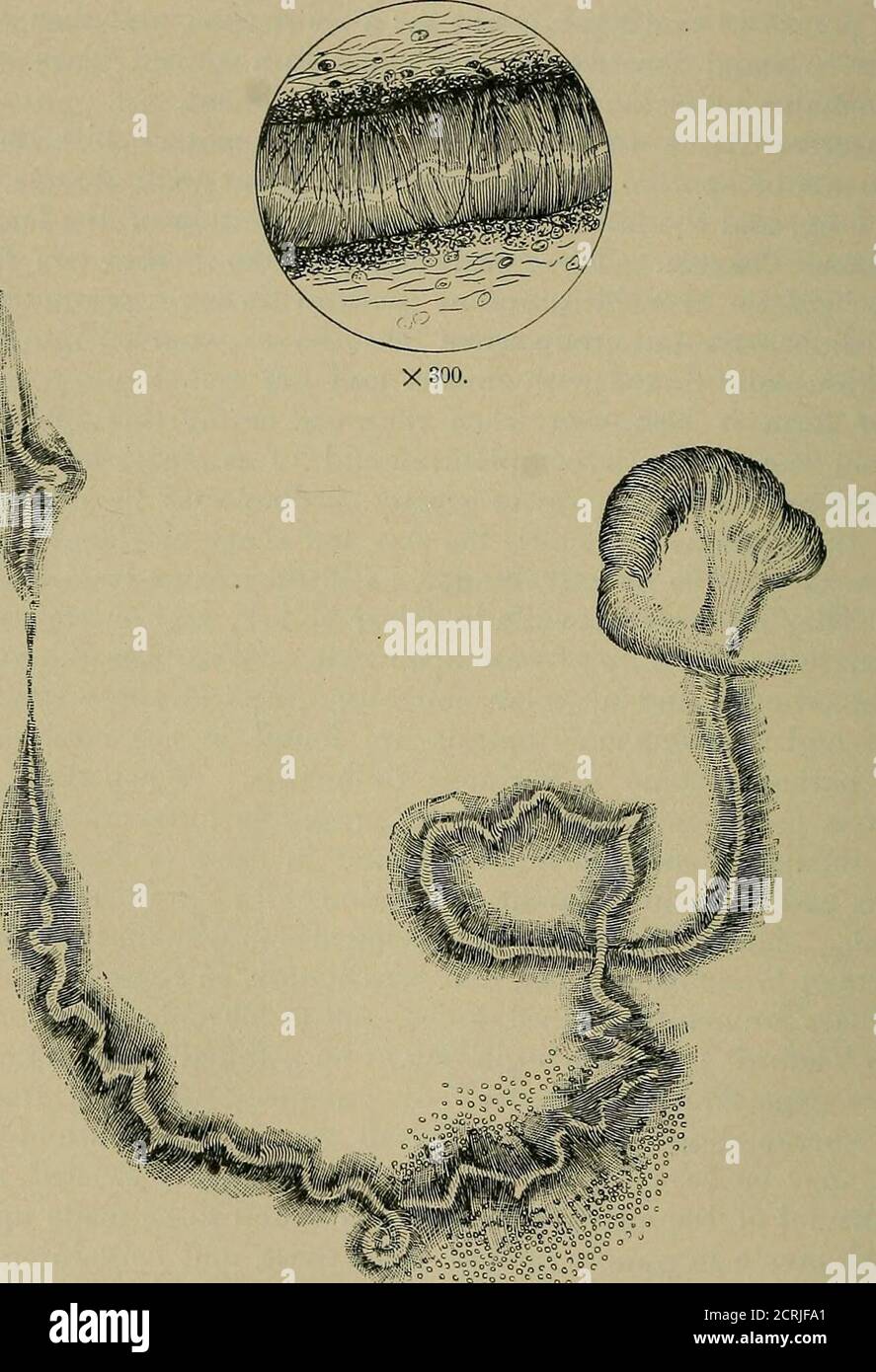 . Un trattato pratico sulla diagnosi medica per studenti e medici i e bronchi. In alcune di queste spirali, un fulgido centralthread corre attraverso l'intero leno;th come un nucleo, notevole per la sua limpidezza e il suo alto indice di rifrazione. Le fibre fini che compongono la spirale possono o non possono essere disposte strettamente. Epitelio e Charcot-Leydcrystals si trovano tra le bobine. Il costituente principale delle spirali è la mucina, e Osier ha suggerito che il filo centrale è costituito da mucina trasformata. D'altra parte, von Jakschprofort^es è chimicamente distinto dalla mucina spir Foto Stock