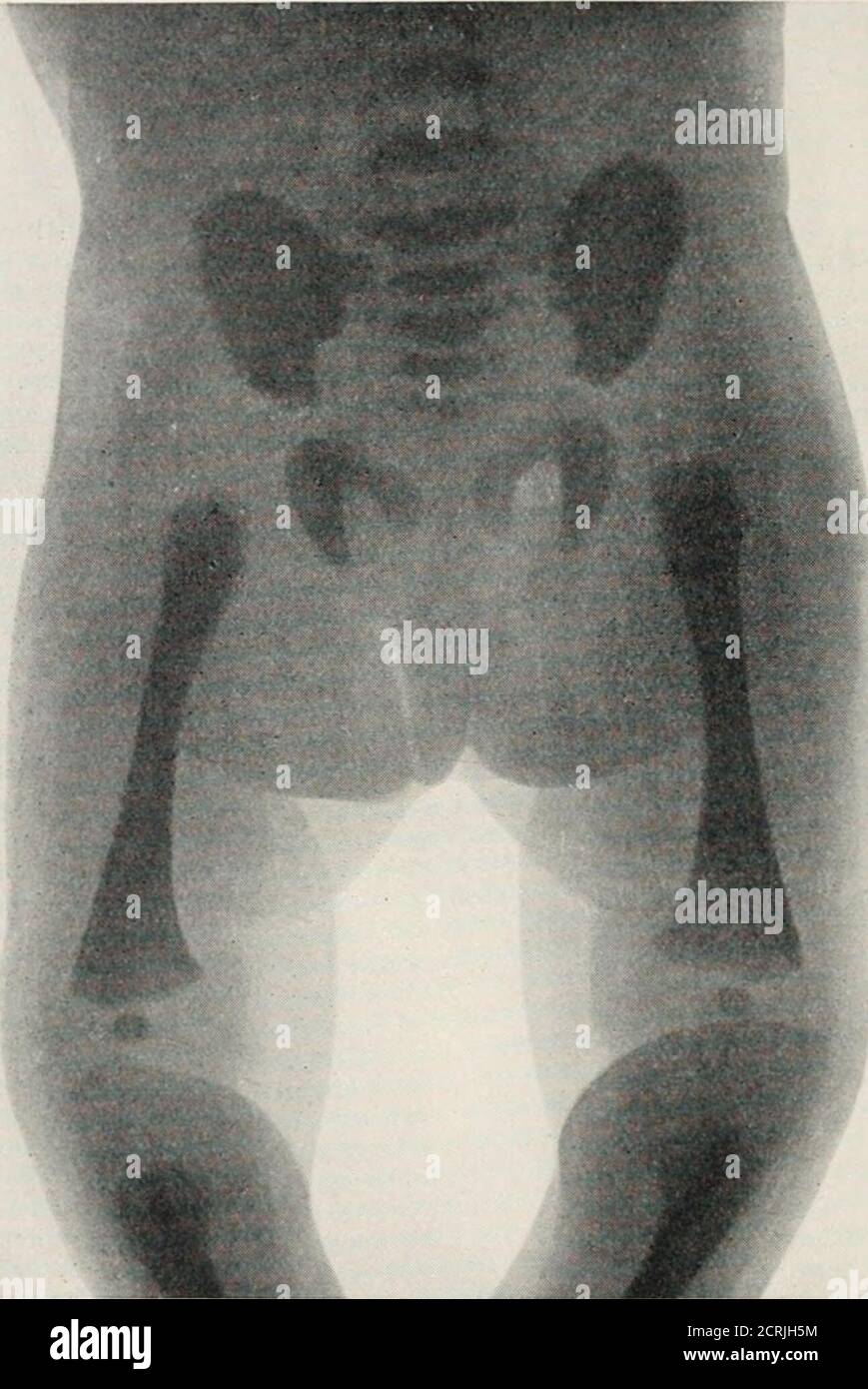 . Radiografia, radioterapia e radioterapia . io. 118.* - diagramma che mostra le epitesie le ossa che entrano nell'articolazione dell'anca. 148 RADIOGRAFIA dell'osso e non fa parte del collo. In un'immagine a raggi X assomiglia in qualche modo all'aspetto dell'epifisi dell'estremità superiore dell'omero. I grandi e minori trocanteri derivano da centri separati di ossificazione, ma questi sono meno frequentemente visti nelle radiografie che non è l'epitisi dell'arger (vedere la piastra IX.a). L'estremità superiore dell'albero delle epifisi del femore della testa ha notennemente apparso l'epifisi per l'offemur dell'estremità inferiore FLG. 119.-Pelvi e femora di A. Foto Stock