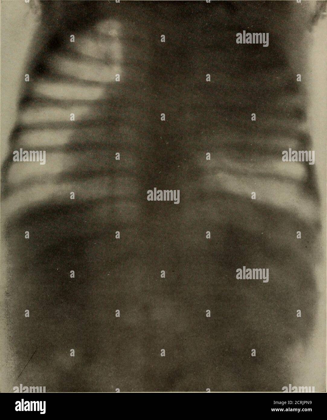 . Anatomia e patologia vivente; . PLATE 115.LOBAR POLMONITE. Ragazza, età 27 mesi. (Ridotto del 28%). (Stesso soggetto delle piastre 65, 116 e 117). Lobo superiore destro non risolto o cavità iniziale. Piastra 115. PIASTRA 116. CONSOLIDAMENTO DEL LOBO SUPERIORE DESTRO. IDIOTA MONGOLO. Ragazza, età 27 mesi. (Stesso soggetto come mostrato nelle piastre 65, 115 e 117). A. un'area di densità ridotta è apparsa nel mezzo della solidificazione. Segni clinici di una cavità. P:LATE 116 I PIASTRA 117. (Ridotto del 31%). (Stesso soggetto delle piastre 65, 115 e 116). L'area di densità A mostra un notevole aumento della radioabilità. IO Foto Stock