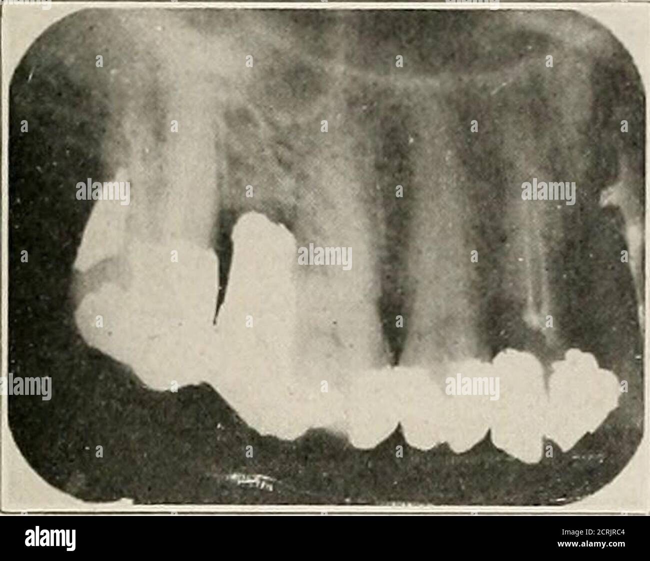 . Interpretazione dei roentgenogrammi dentali e mascellari . Fig. 124. Fig. 125. Fig. 124.-canino superiore sinistro e premolari primo e secondo. Pulps vitale. Linea Normalpericemental vista intorno alle radici. In figura è mostrato anche il pavimento del seno mascellare. Fig. 125.-Nessuna anomalia periodica. Apici del secondo premolare e della prima molarvery vicino al pavimento del seno macillare. INTERPEETATION DI ROENTGENOGRAMS 101 Regione superiore sinistra. Foto Stock