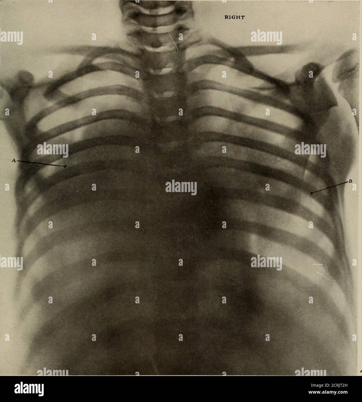 . Anatomia e patologia vivente; . PIASTRA 112.POLMONITE LOBARE DA PNEUMOCOCCO DOPPIO. Ragazzo, 12 anni. (Ridotto del 42%). A. consolidamento del lobo inferiore sul lato sinistro. B. consolidamento dei lobi medio e inferiore sul lato destro. Piastra 112. PLATE 113.LOBAR POLMONITE. Bambino, età 10 anni. (Ridotto del 42%). A. solidificazione del lobo inferiore destro con un'area che mostra un consolidamento ridotto appena sopra di esso. A causa del lackof movement nel polmone, prodotto dalla sua solidificazione, i bronchi dei lobi superiori, specialmente a destra, sono diventati abbastanza distinti. B. consolidamento della parte inferiore sinistra Foto Stock