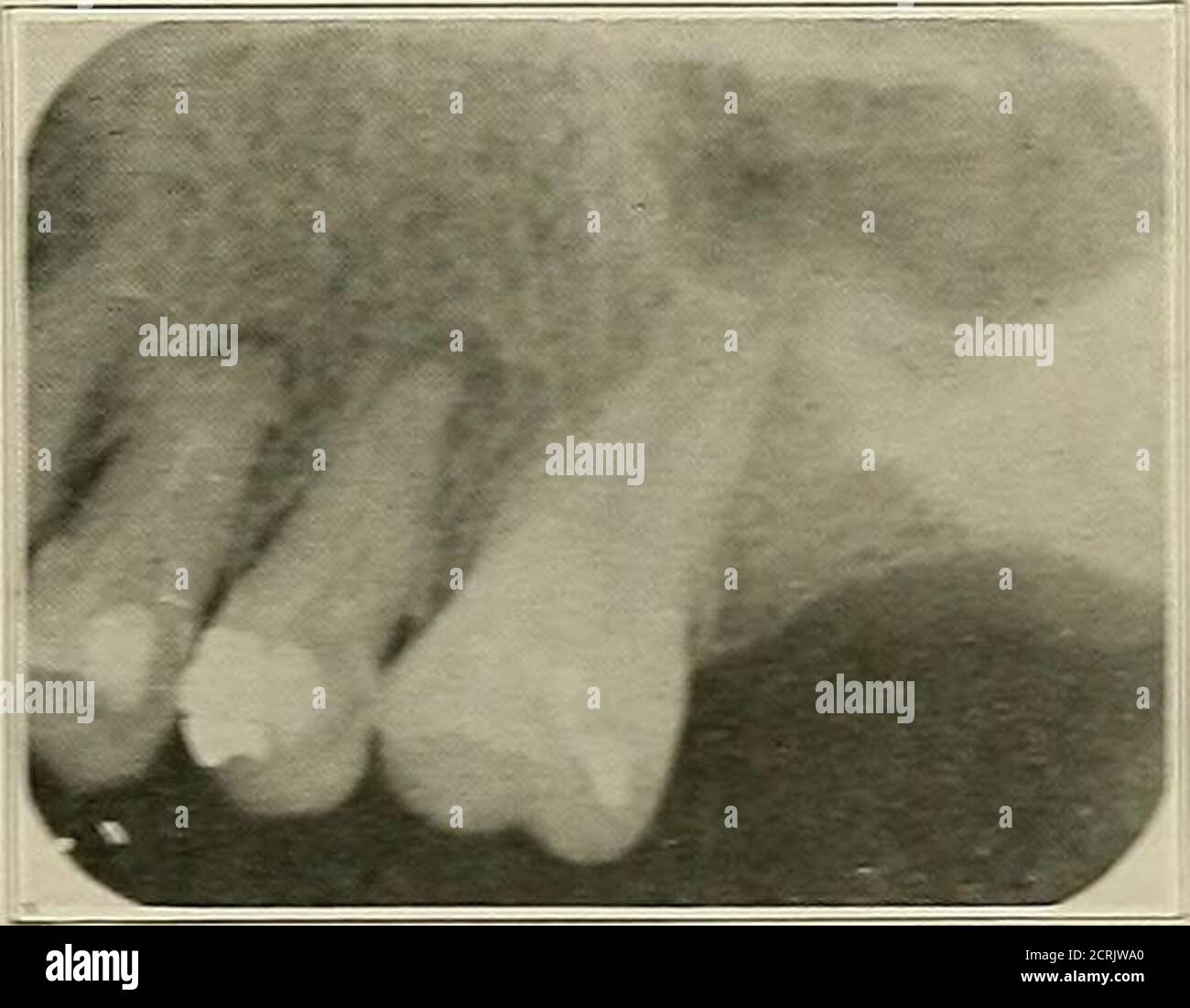 . Radiografia dentale e orale; un libro di testo per studenti e professionisti dell'odontoiatria. Molari inferiori che mostrano la presenza di un grande ascesso alveolare. E per com^riempire canali radicolari, l'x-RAA^ offre un aiuto indispensabile. Prima di considerare il trattamento di un dente (o di un dente), deve essere fatto un radiogramma per mostrare la topografia delle radici da trattare. Se questi sono dimostrati essere ana-tomicamente all'interno del campo di trattamento, un tentativo maythen essere fatto per rimuovere tutto il materiale organico dai thecanals e per aprirli fino al foramen molto apicale.i fili diagnostici fini dovrebbero quindi essere inseriti e c Foto Stock