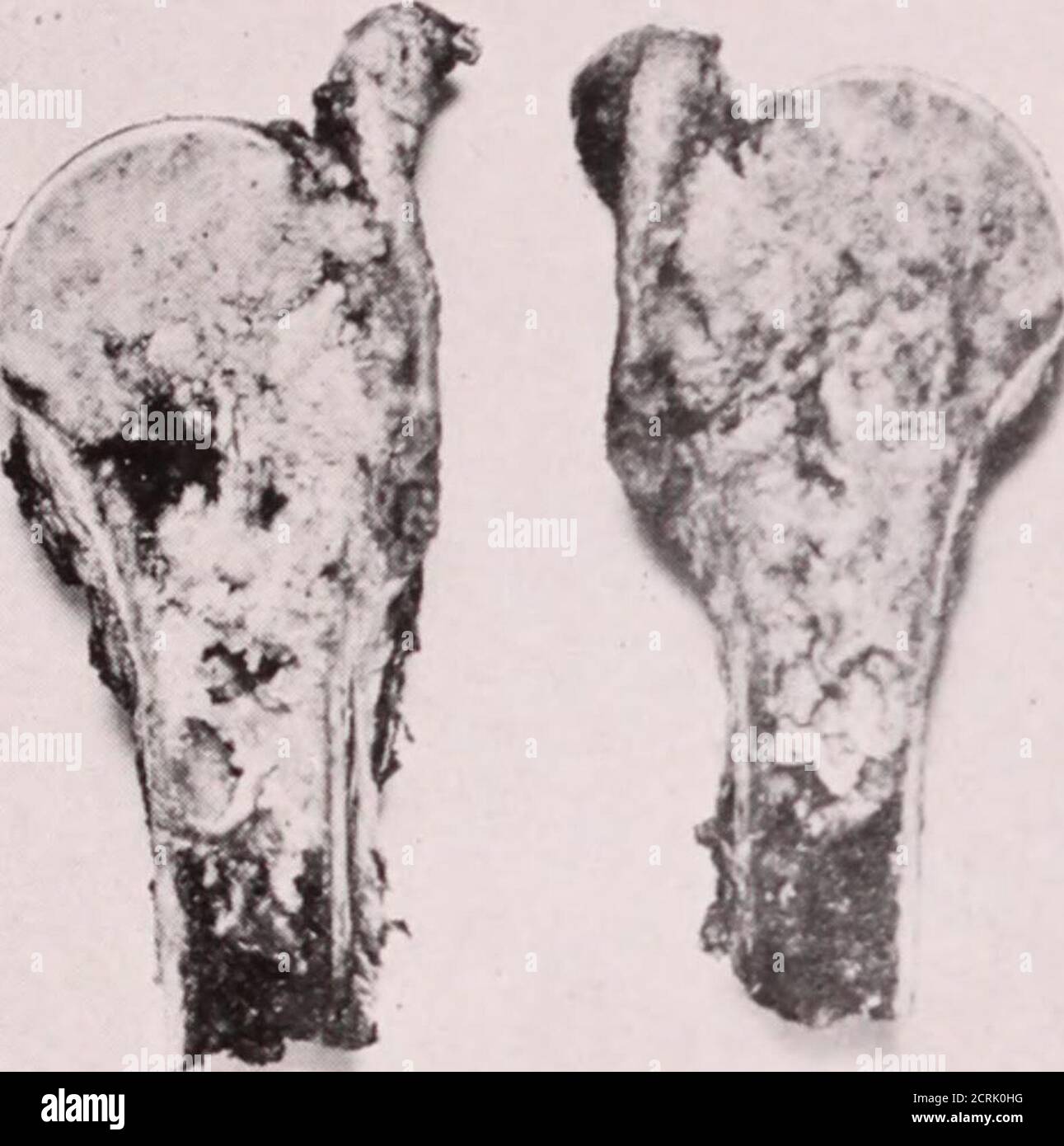 . Giornale di radiologia . Fig. 17.-caso VI. Fotografia di un campione grossolano, che mostra in X l'area in cui si poteva avvertire la crepitazione. Aumento delle dimensioni del tumore e distruzione corticale. L'operazione è stata eseguita a partire da questi risultati, una pagina tredici TUMORI PRIMARI DI OSSO: La diagnosi di sarcomaè stata positiva SOSMAN E CANTER. Operazione la mattina dell'opera, la palpazione ha rivelato un areaof distinto crepi- simile a una pergamena. FIP. IS. - caso VI. Longitudinalsection attraverso campioni lordi che mostrano l'espansione dell'albero discendente del tumore, l'area centrale del tumore della distruttionina e la perforazione Foto Stock