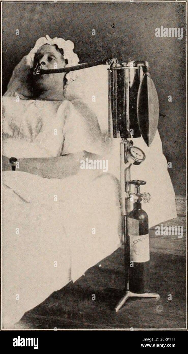 . Giornale di radiologia . ely non deve essere usato,poiché la tiroxina aumenta la combustionedel tessuto muscolare invece del tessuto adiposo. 4. Estrema cachessia, come nella tubercolosi, diabete, inedia prolungata, ecc., (fino a meno trenta per cento). 5. Persone in perfettamente normalsalute, ma in esecuzione basse frequenze cardiache, sayas basso come cinquanta, può mostrare un metabolismatismo basso come meno venti per cento. 6. Malattia di Addisons (circa minustrenta per cento). Combinazioni di queste conditionpossono dare qualsiasi tipo di un tasso, cioè, anemaciated tuberculous patient withFever può essere basso a causa di teemaciazione o alto a causa Foto Stock