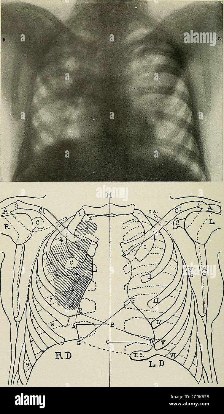 . Röntgen raggi ed elettroterapeutici : con capitoli su radioterapia e fototerapia . Fig. 177.-tubercolosi del polmone destro (vista posteriore, e una traccia fotografica dello stesso.lo skiagraph mostra il consolidamento dell'apice destro e della base destra; il cuore è spostato verso il tramonto. A, processo acromione; Sp, processo spinoso cf scapola; ci, clavicola; C, processo coracoide; 1, 2, 34, 5 6, 7, 8, 9, 10, nervature (posteriori); i, II, III, IV, nervature (anteriori). Fig. 178.-tubercolosi dell'apice destro (vista anteriore). Piastra posizionata di fronte al torace. Il Thechest dello stesso paziente come mostrato in Fig. 177. Il Foto Stock