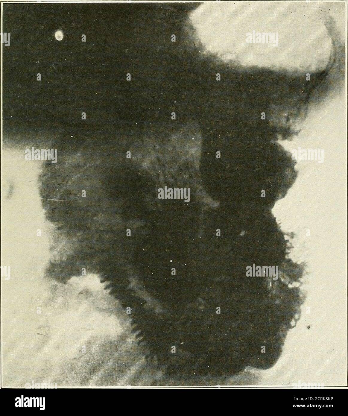 . Roentgen interpretation; un manuale per studenti e professionisti . Fig. 132.-stomaco normale delle creste dell'ilia. La curvatura maggiore si trova ad una distanza variabile al di sotto del minore. La forma e la posizione DELLO STOMACO 157 sono determinate dall'architettura dell'individuo, dal tono della parete gastrica, dalla tensione dei muscoli addominali, dalla pressione degli organi vicini e dalla quantità del pasto. Gli individui sottili con un arco costale stretto hanno lunghi stomachi centrali che sbarrano nel bacino. In individui ampi e grassi con un ampio arco costale e in quelli di forte muscolatura Foto Stock